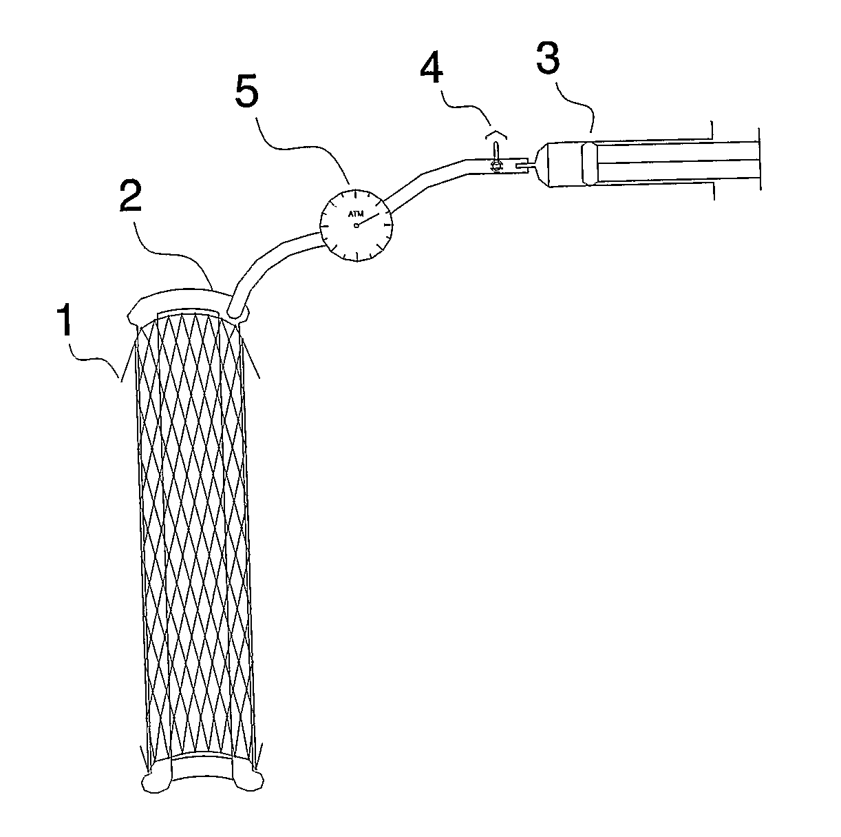 Extraluminal stent type prosthesis for anastomosis