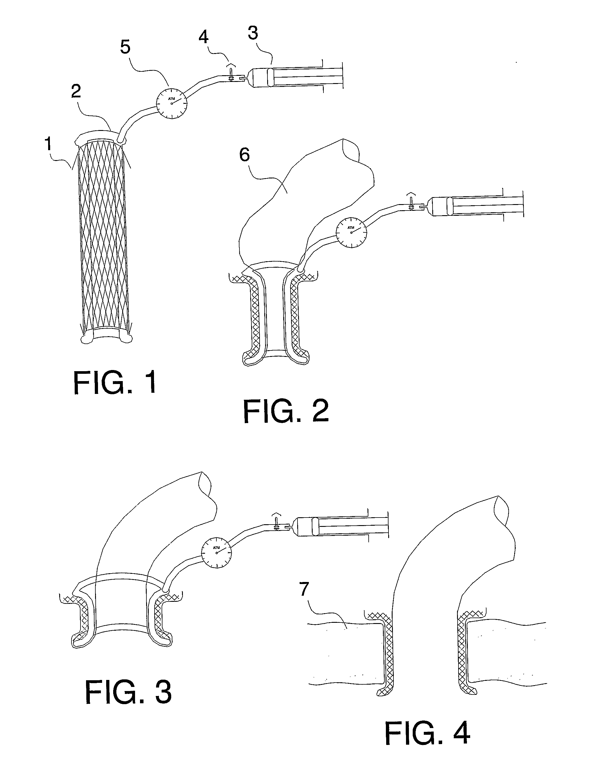 Extraluminal stent type prosthesis for anastomosis