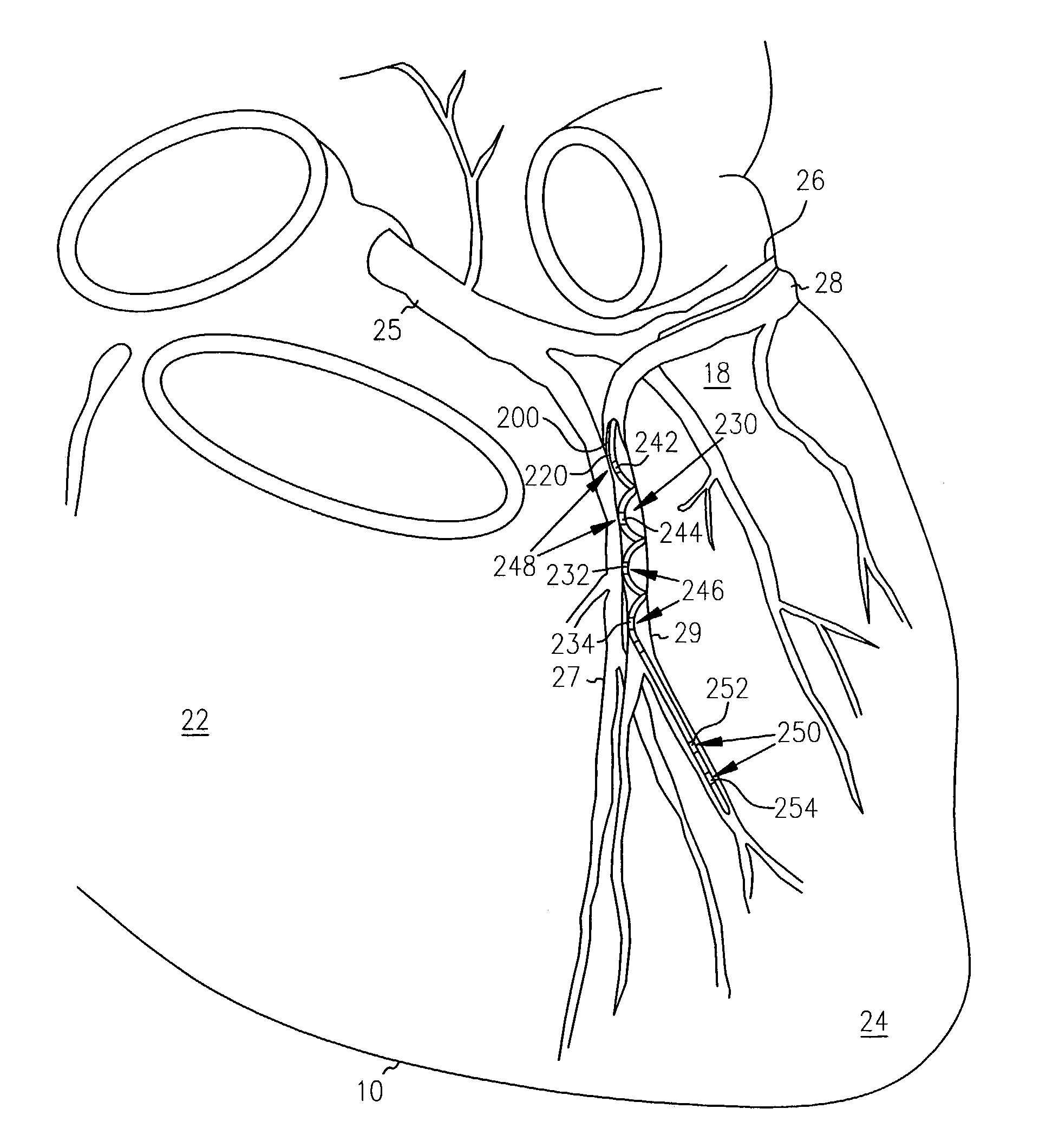 Leads for pacing and/or sensing the heart from within the coronary veins