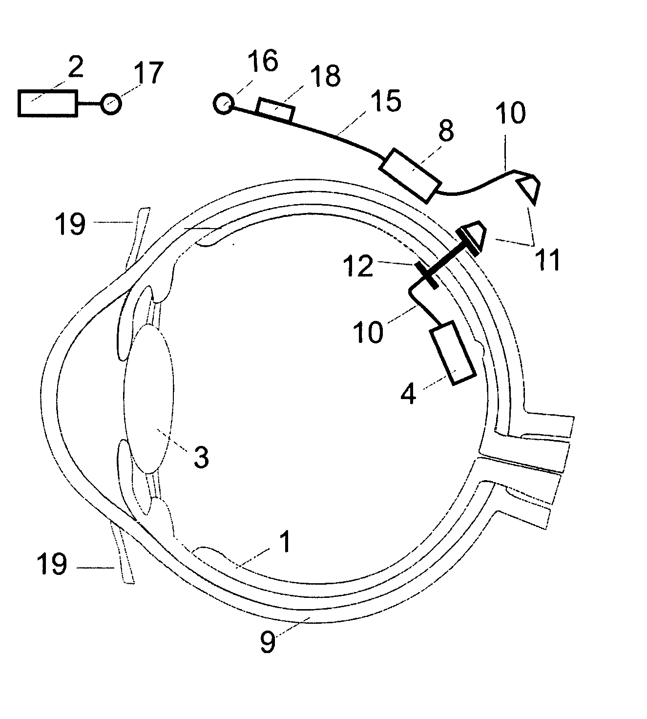 Retinal implant with improved implantation and working properties