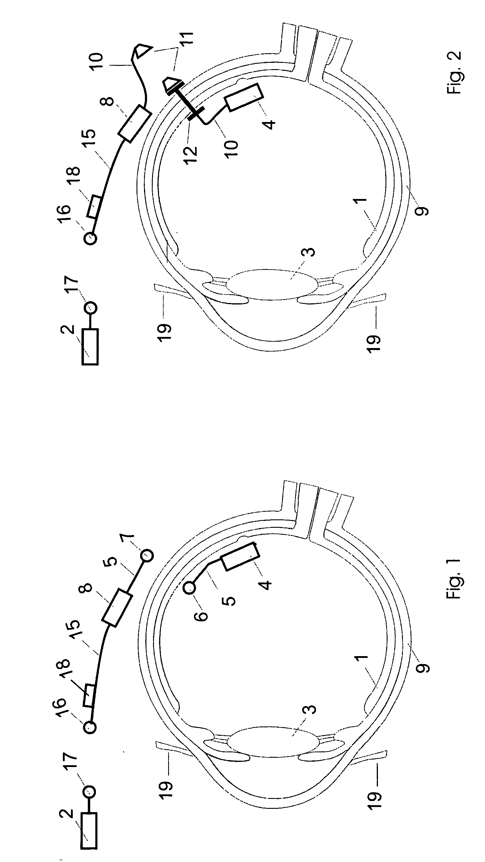 Retinal implant with improved implantation and working properties