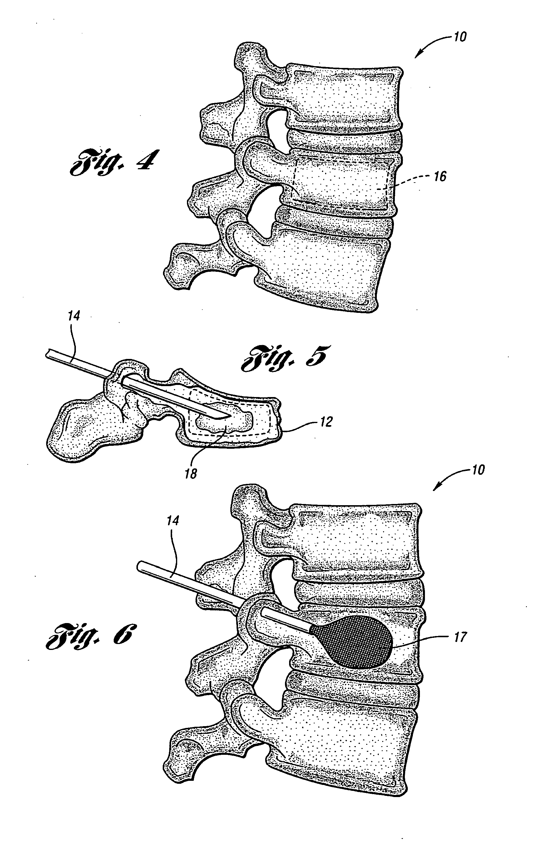 Vertebroplasty all in one mixer