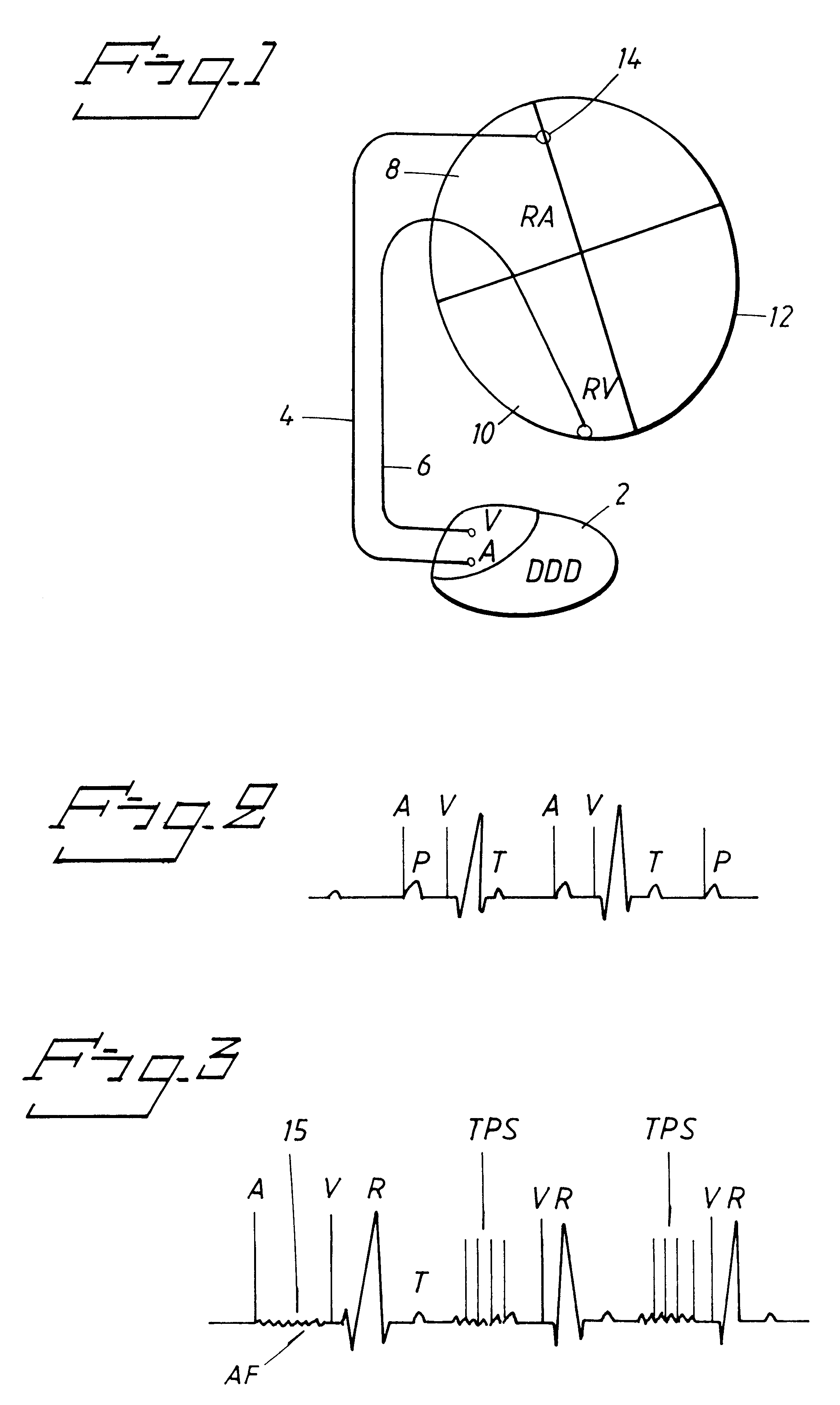 Heart stimulator for administering antithrombus therapy