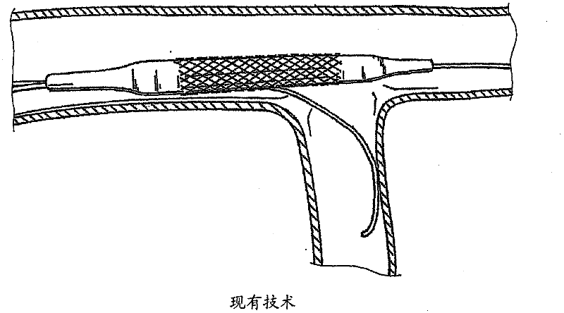 Navigation guide wire through an anatomical structure having branched ducts