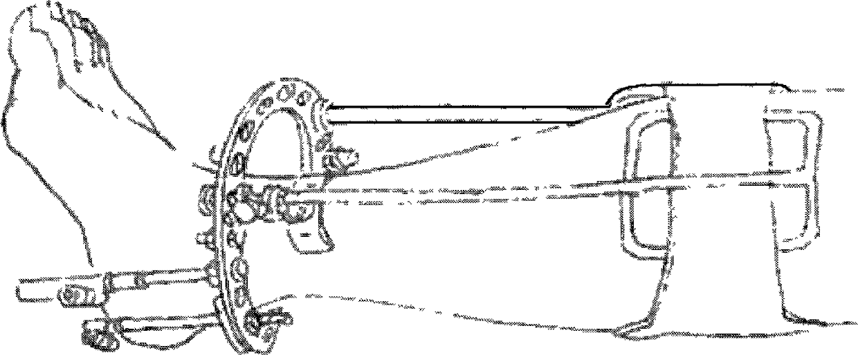 Osteopathic ankle joint complicated fracture treatment fixer