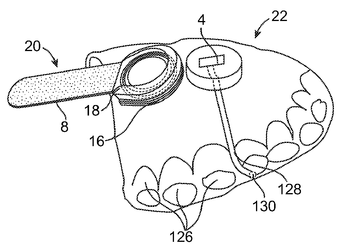 On-off implant for supporting the tongue