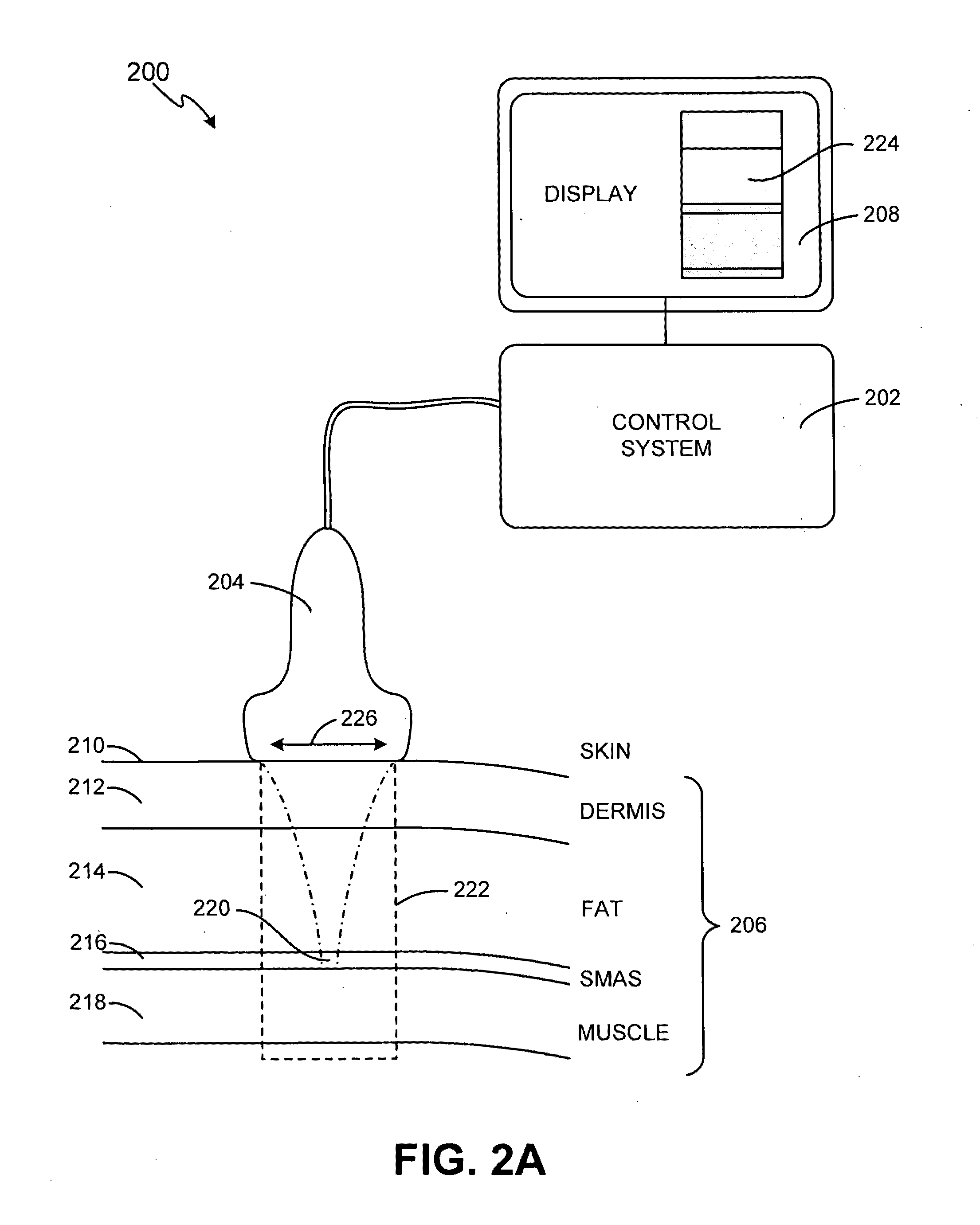 Energy-based tissue tightening