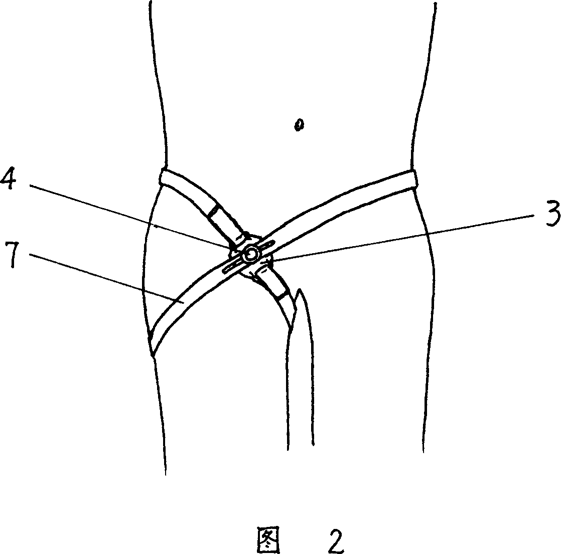 Disposable arteria femoralis compression hemostat