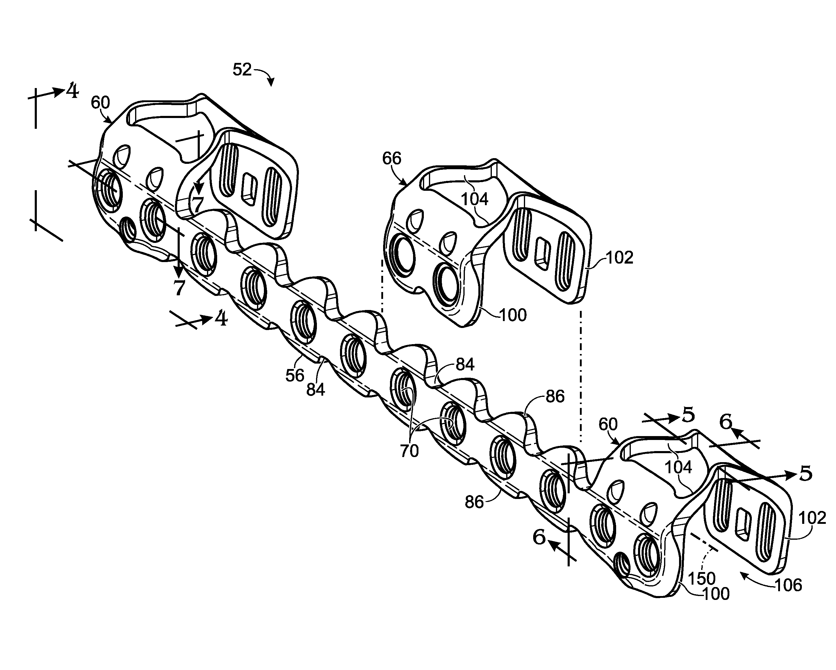 Bone fixation system with opposed mounting portions