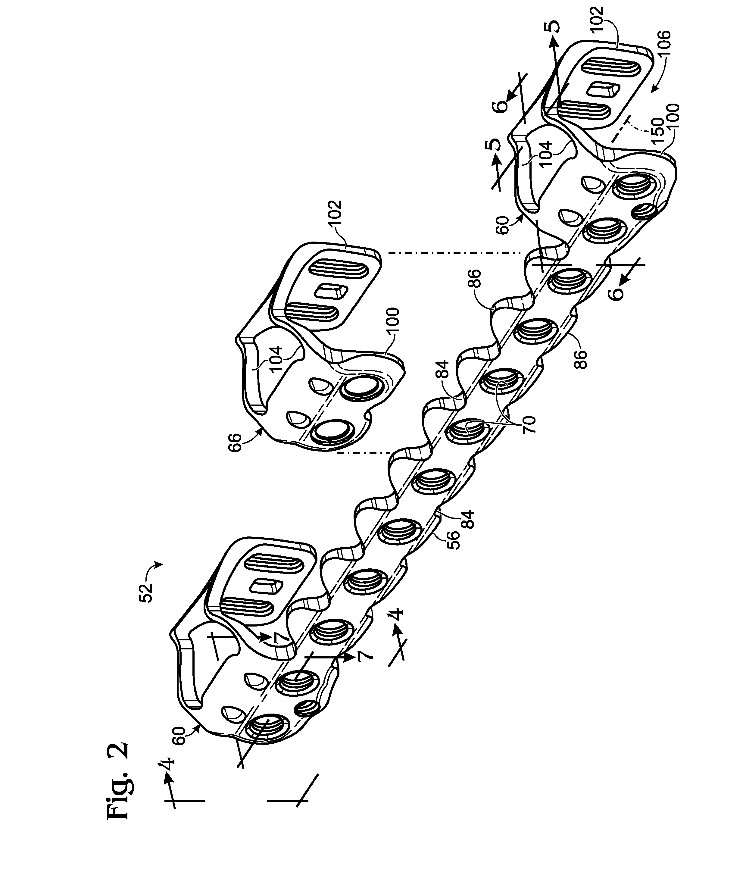 Bone fixation system with opposed mounting portions