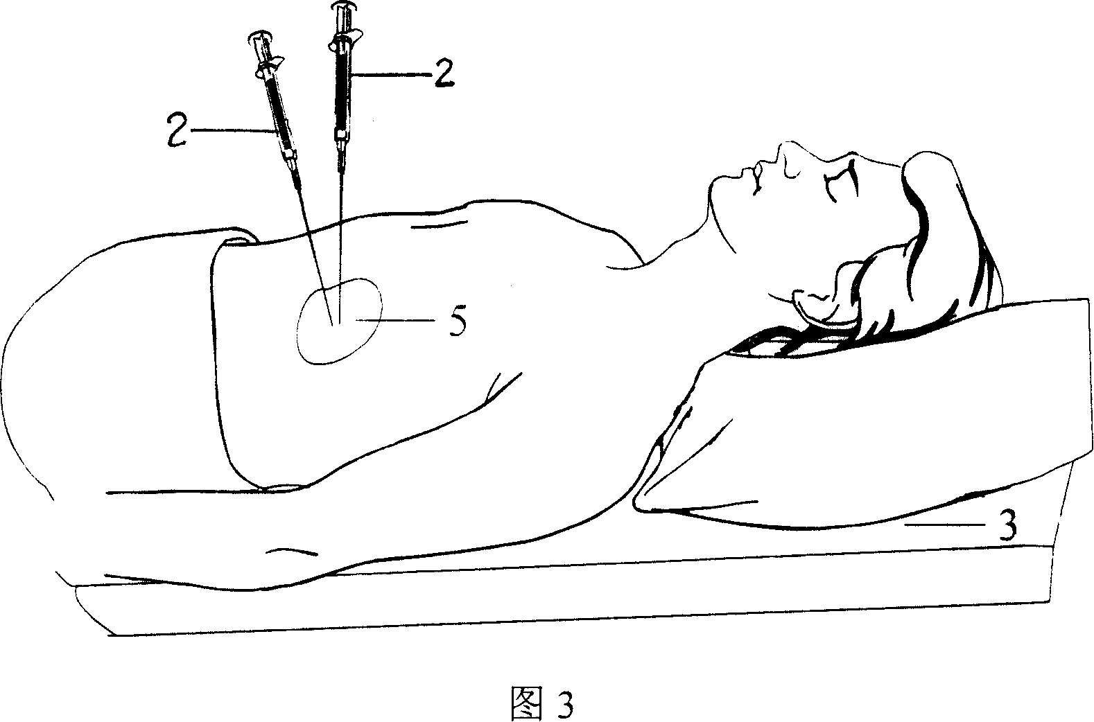 Knub thermotherapy based on exothermic chemical reaction