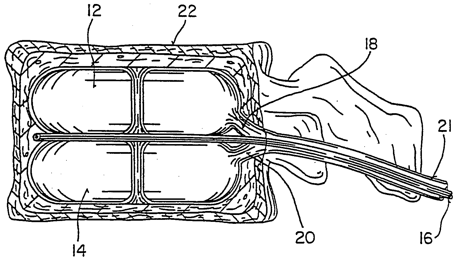 Inflatable device for use in surgical protocol relating to fixation of bone