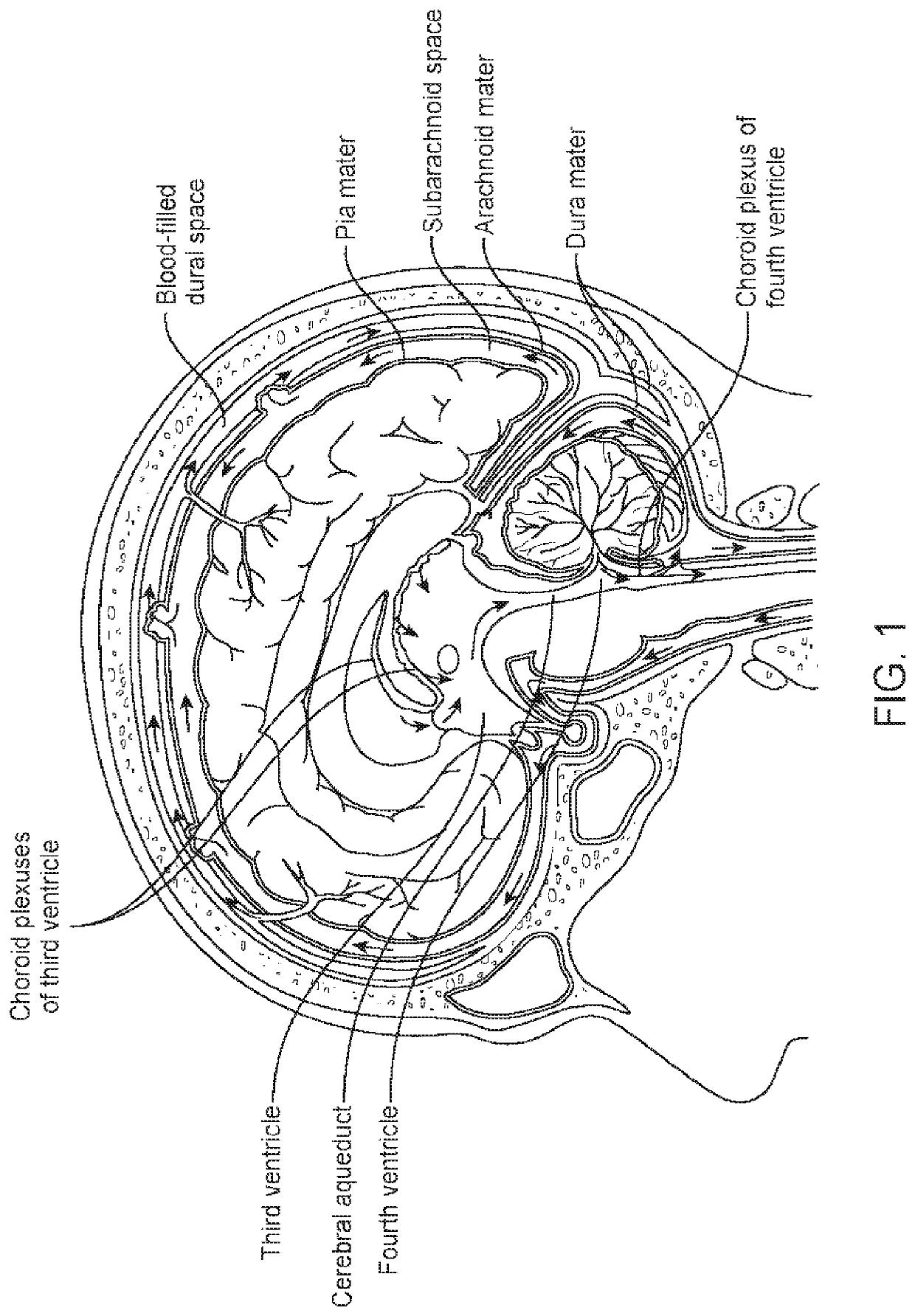 Composite dura substitute implant