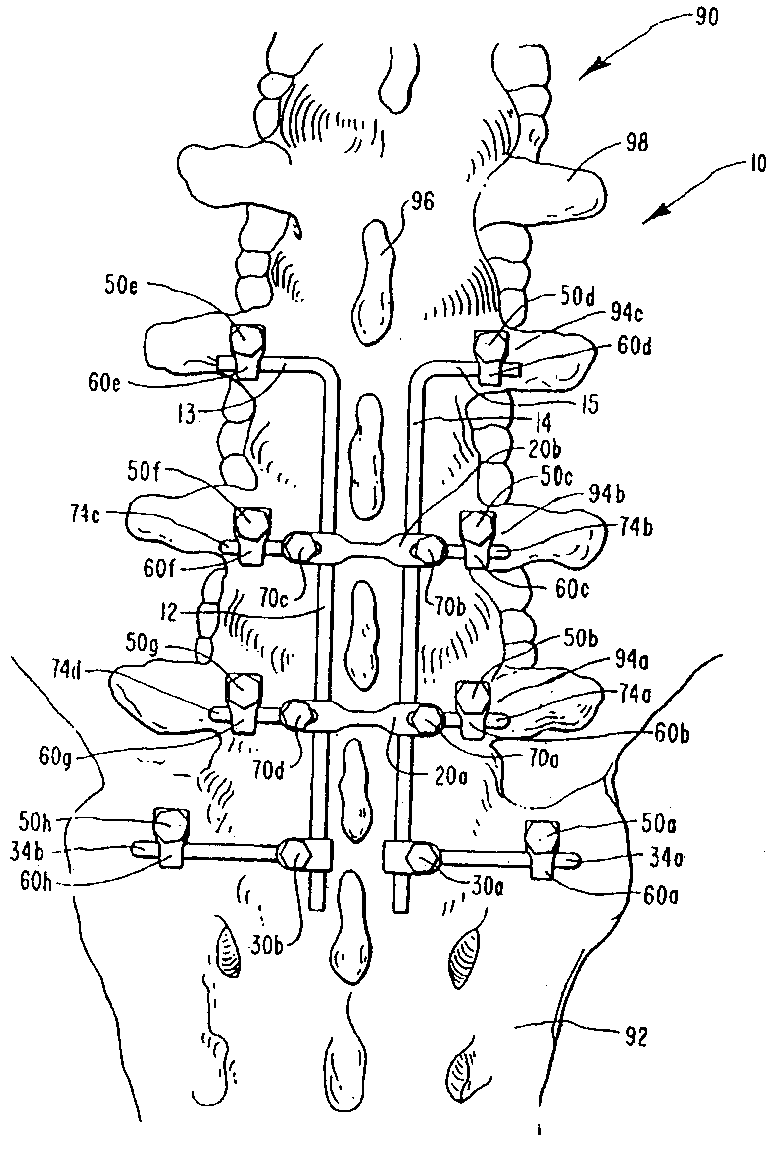 Spinal fixation apparatus and method