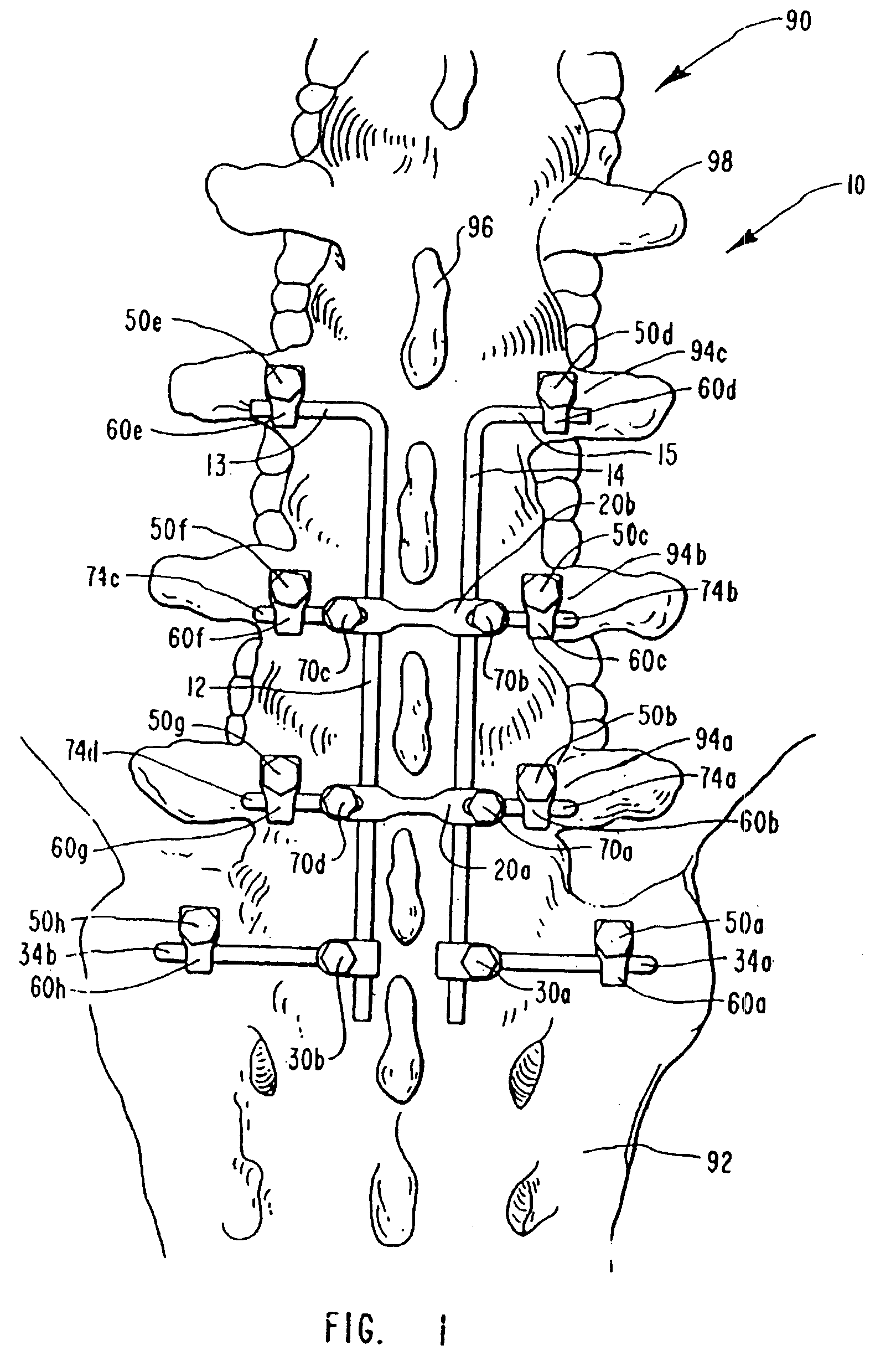 Spinal fixation apparatus and method