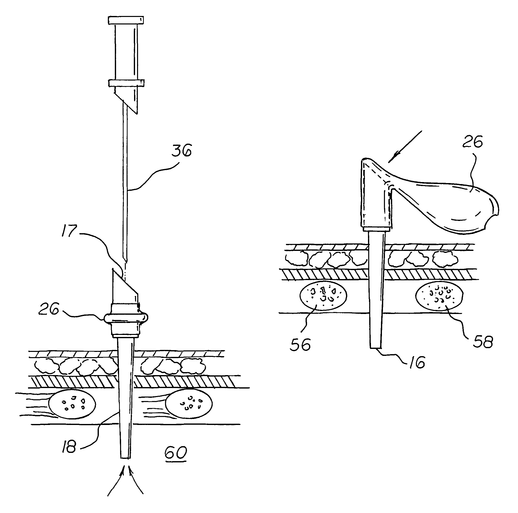 Pneumothorax relief valve method