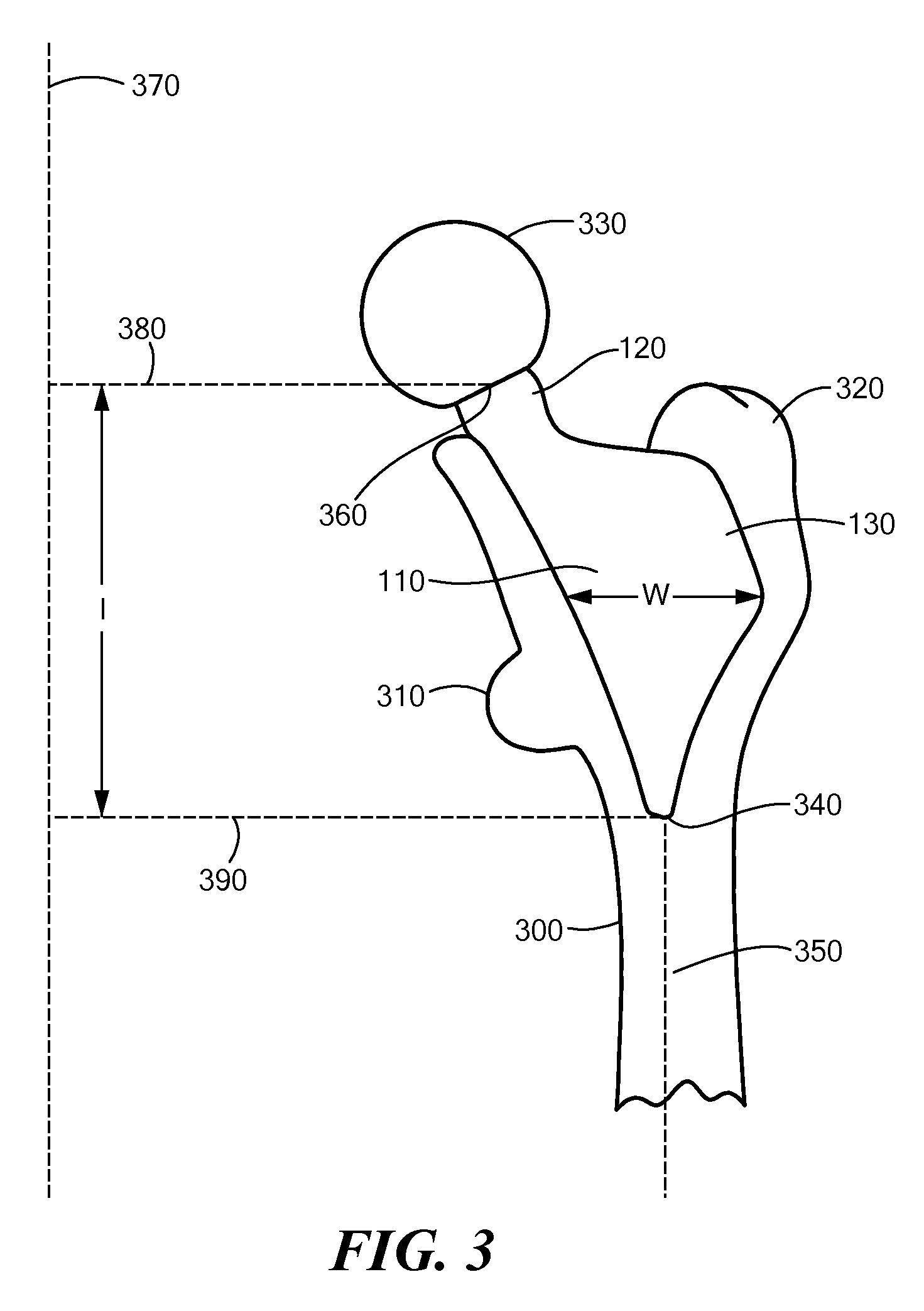 Proximally Self-Locking Long Bone Prosthesis