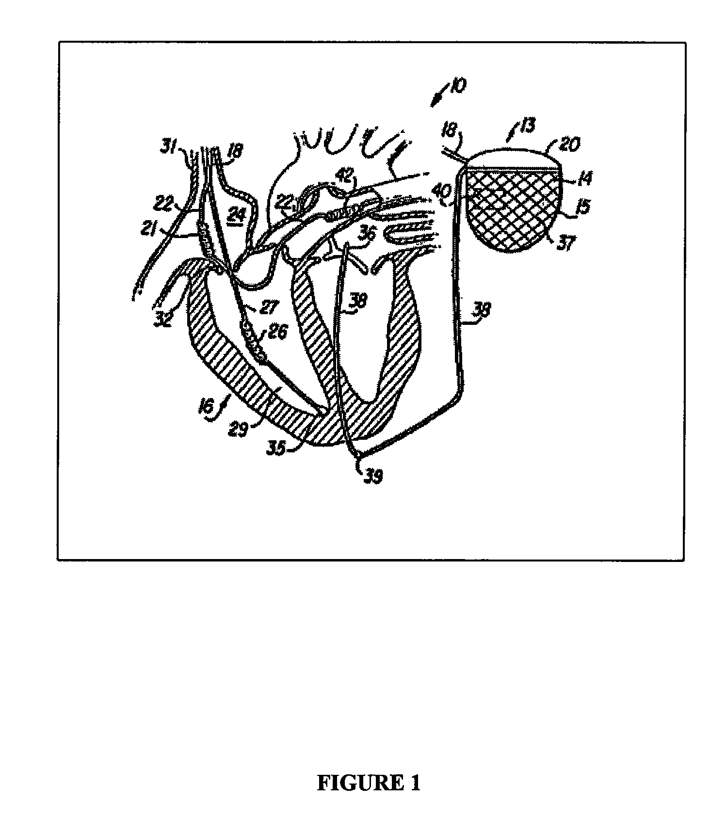 Electrocardiogram reconstruction from implanted device electrograms