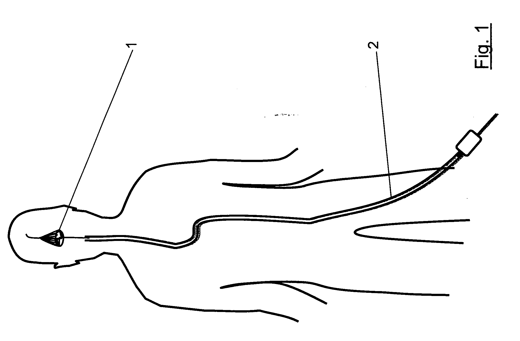 Clot capture systems and associated methods