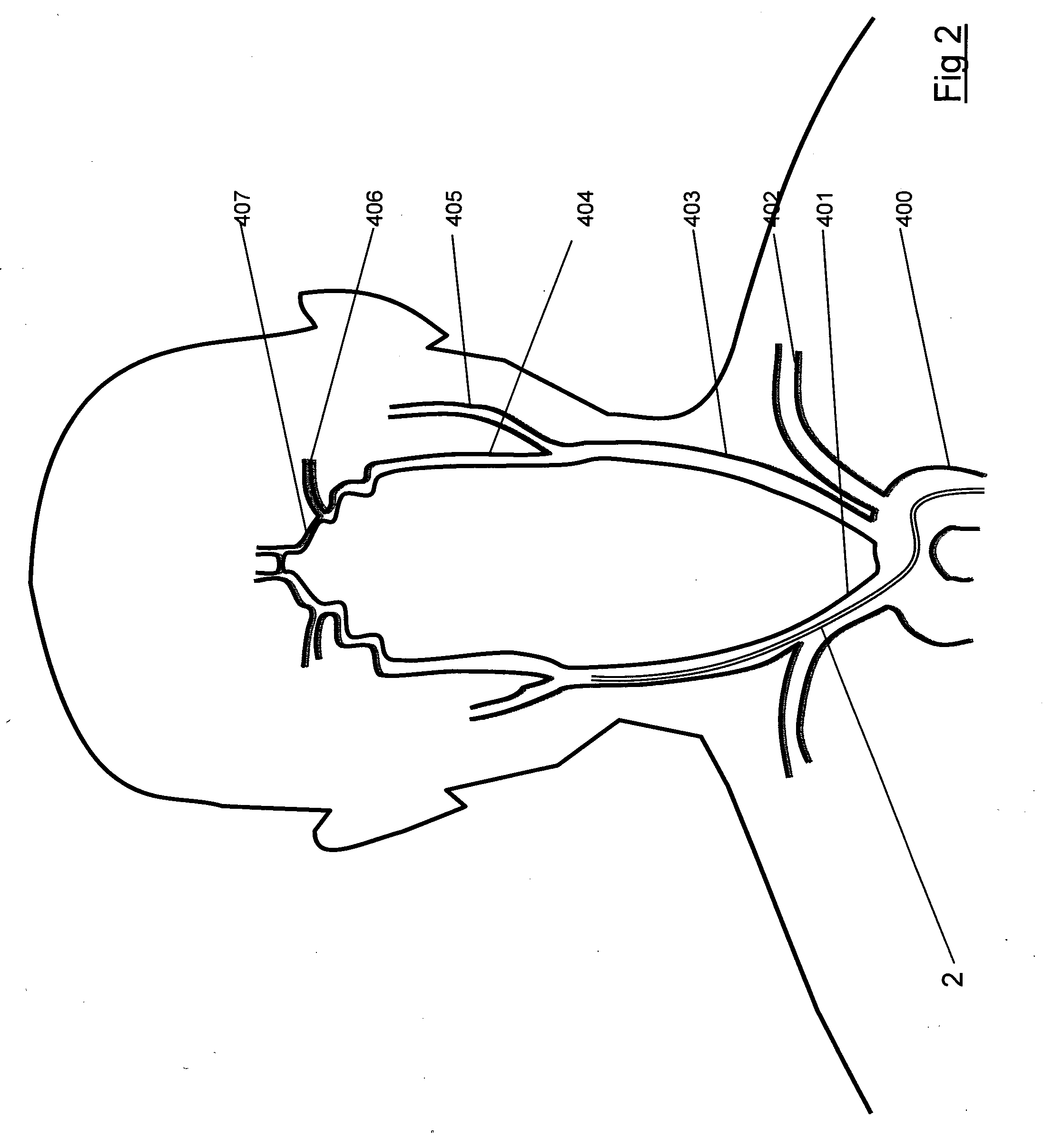 Clot capture systems and associated methods