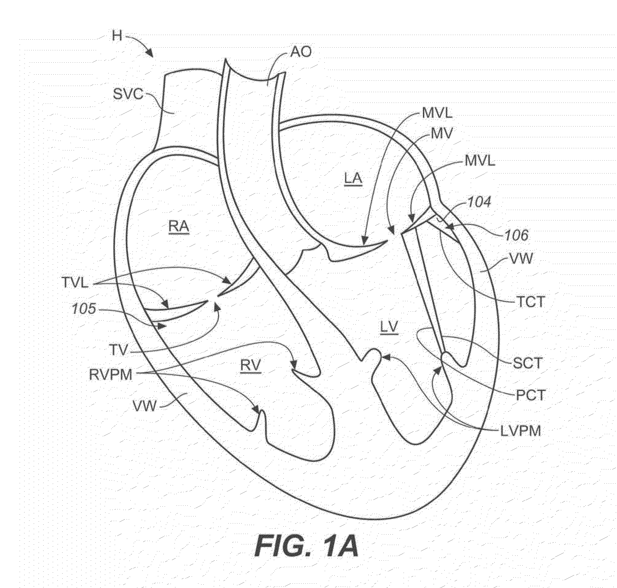 Diagnostic catheters, guide catheters, visualization devices and chord manipulation devices, and related kits and methods