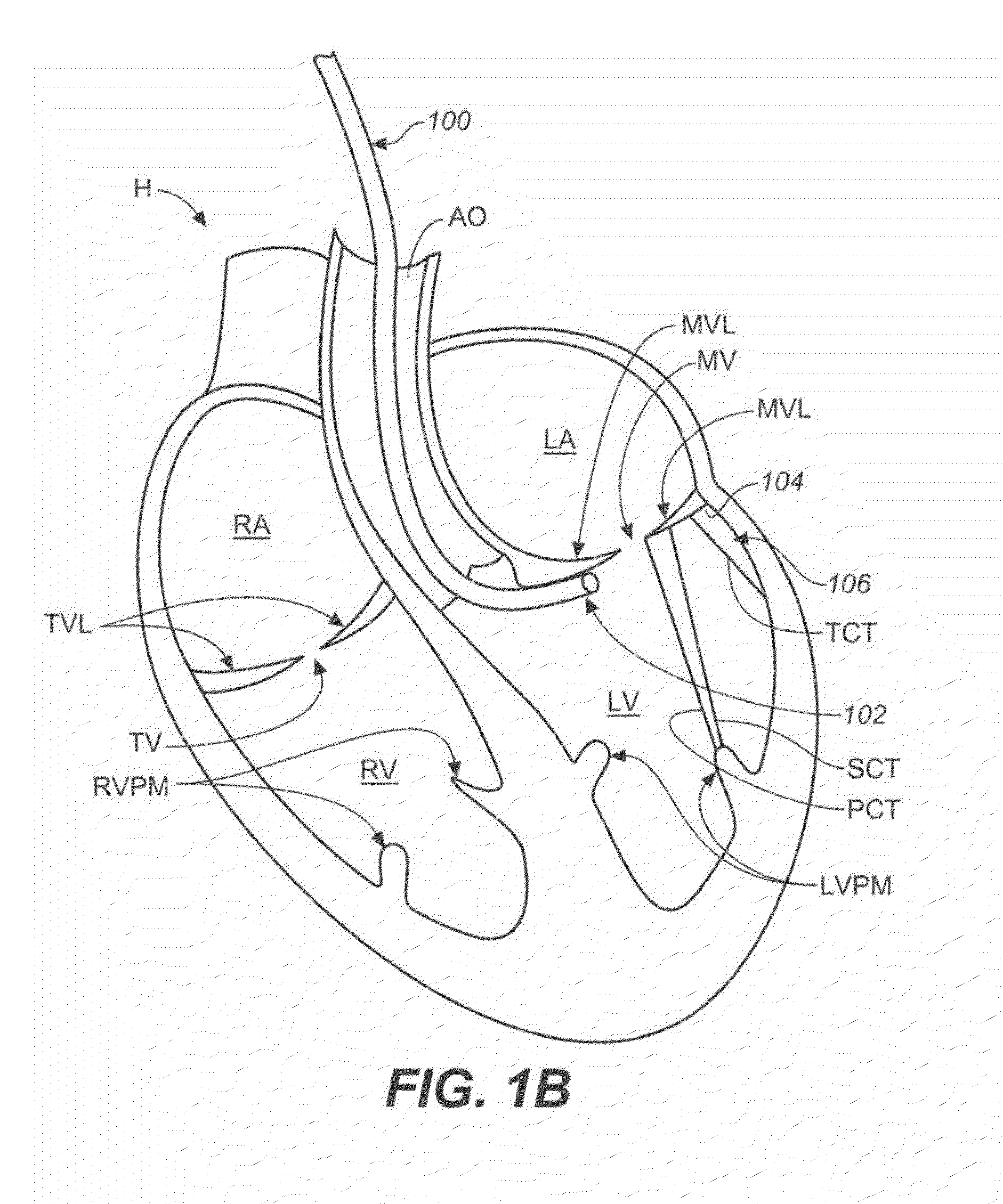 Diagnostic catheters, guide catheters, visualization devices and chord manipulation devices, and related kits and methods