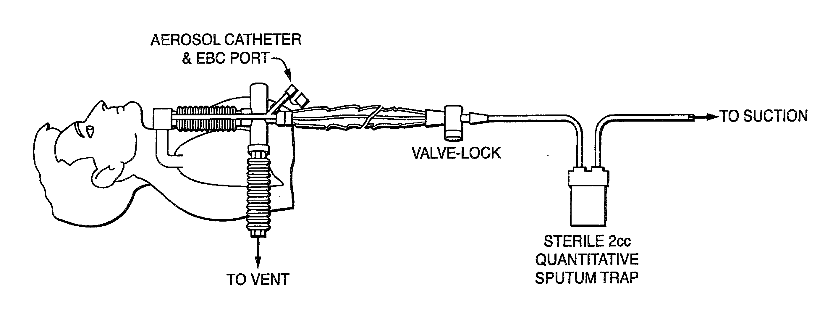 Methods, devices and Formulations For Targeted Endobronchial Therapy