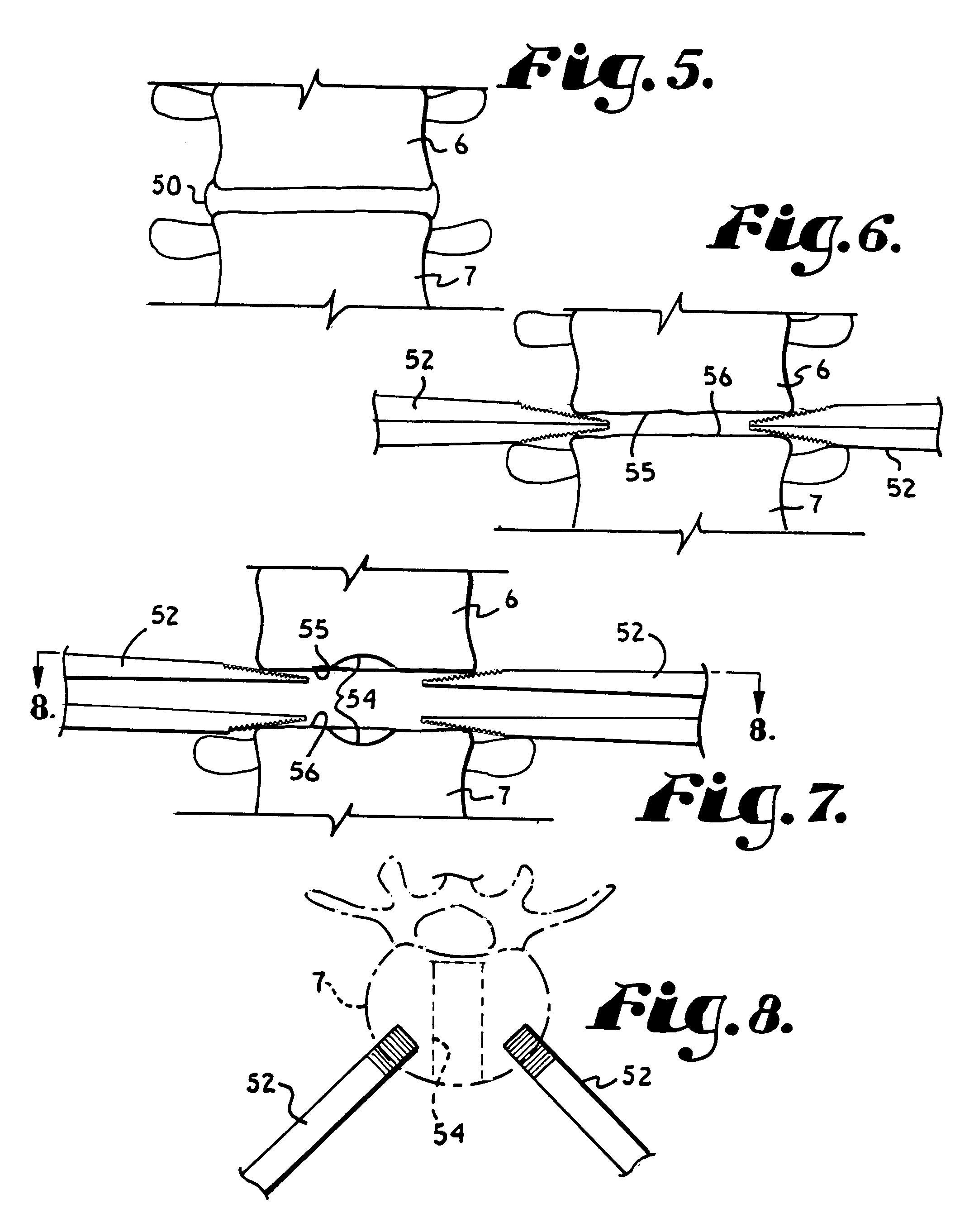 Threaded center line cage with winged end gap