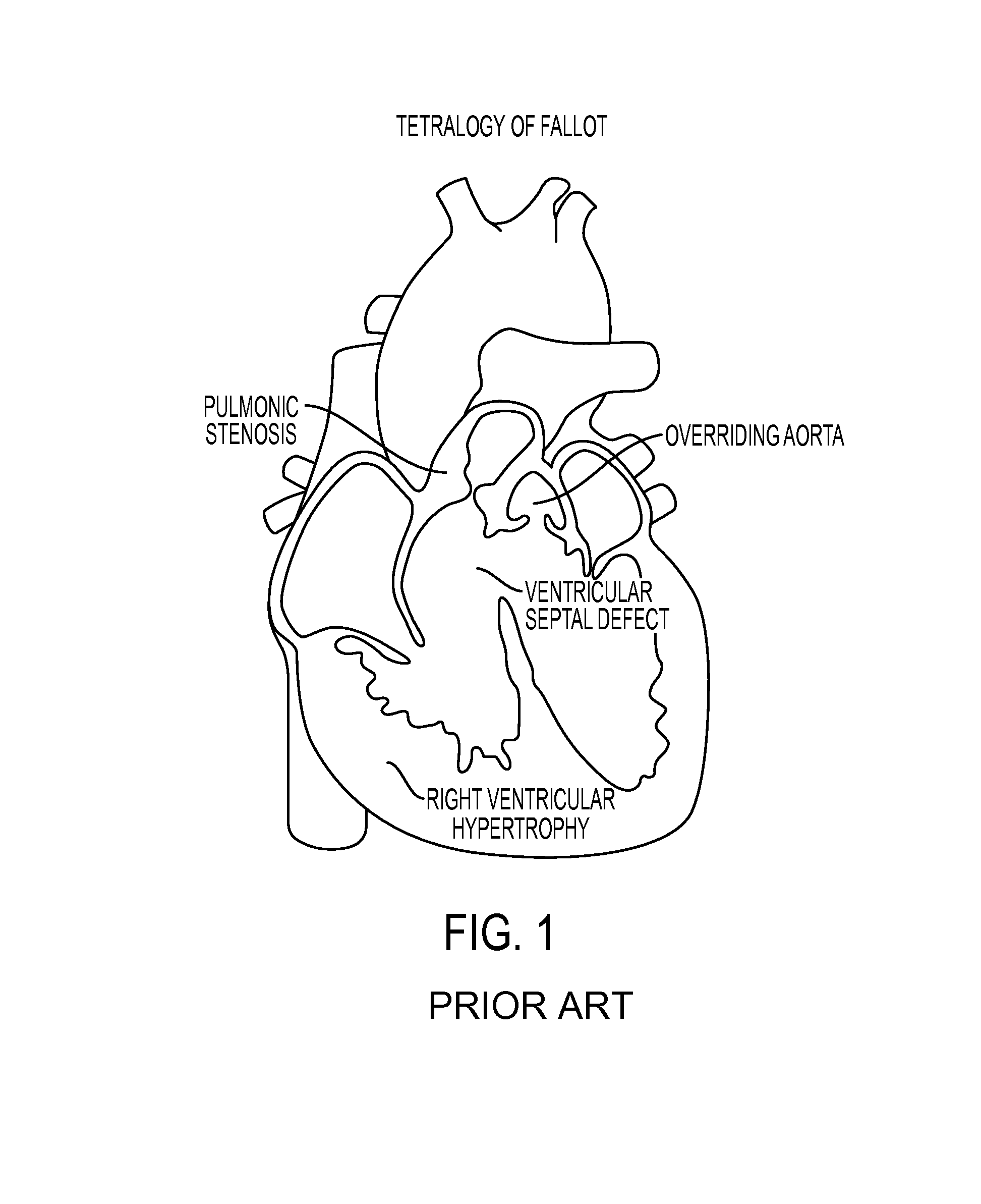 Dynamic pulmonary trunk modeling in computed tomography and magnetic resonance imaging based on the detection of bounding boxes, anatomical landmarks, and ribs of a pulmonary artery