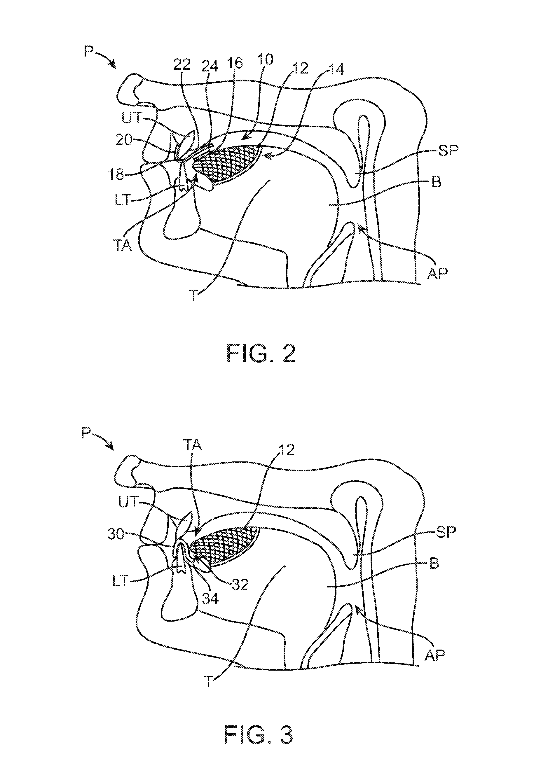 Tongue retention system