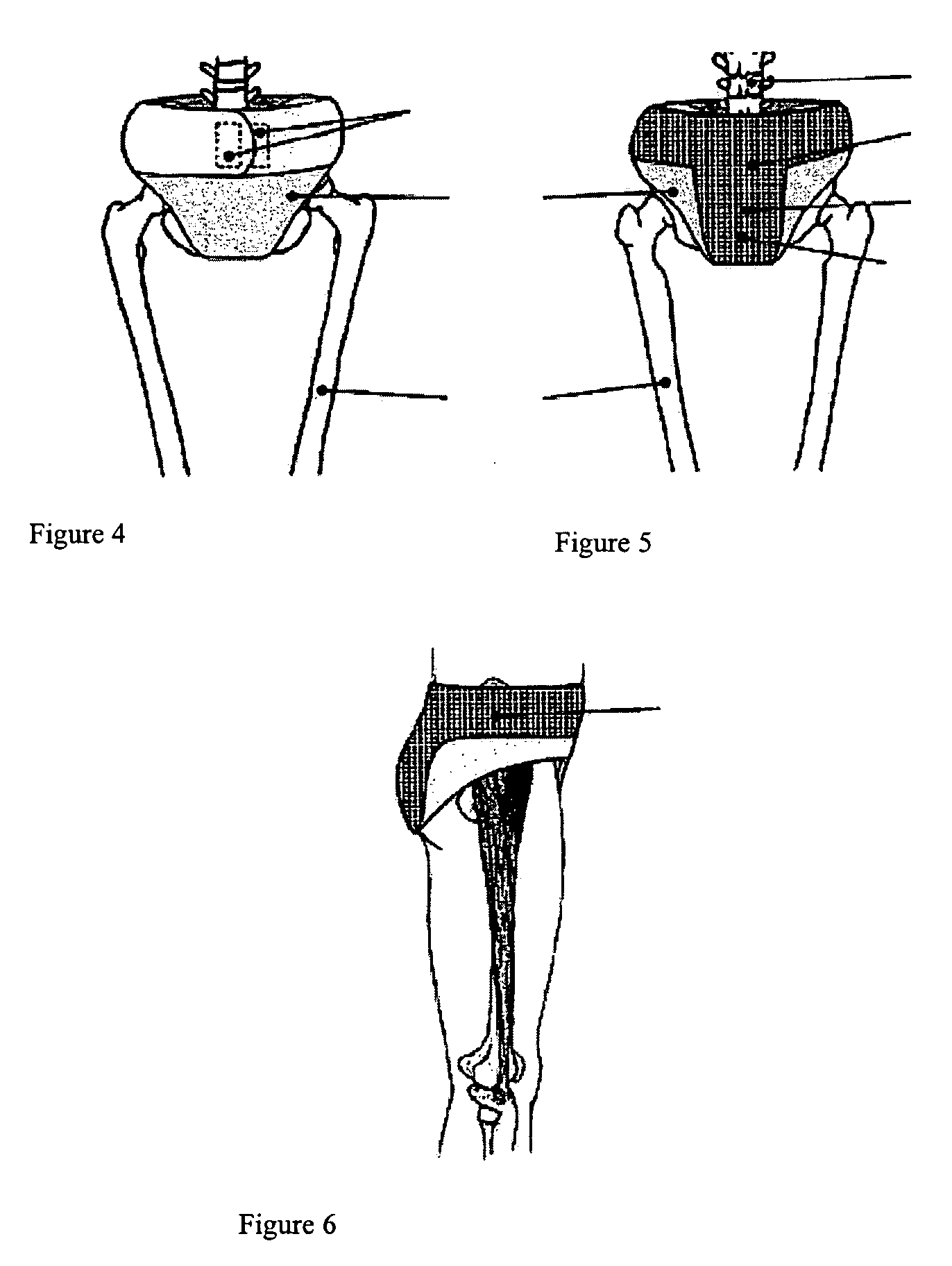 Overlay garment for improving muscle tone