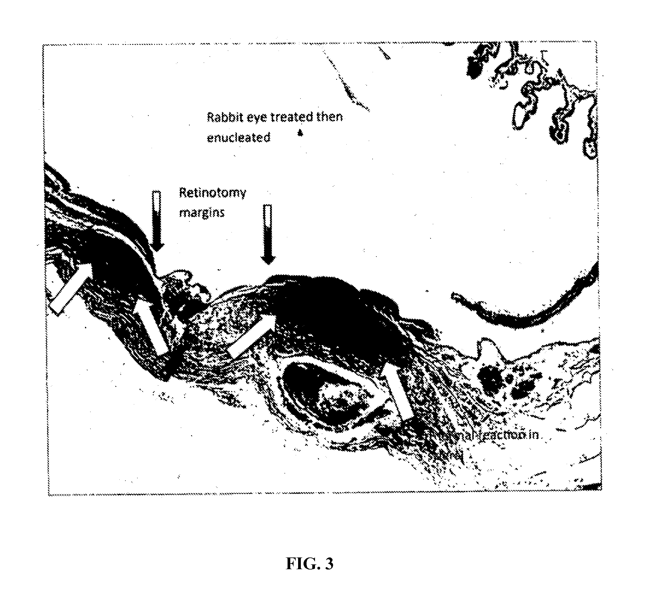 Method and device for treating retinal detachment