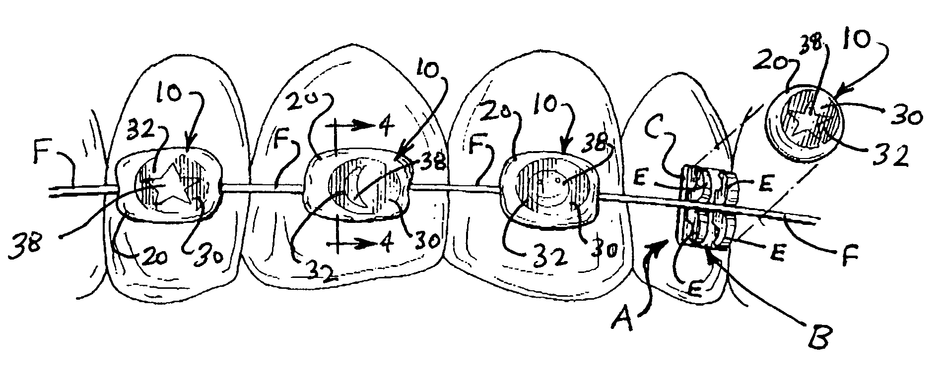 Elastomeric orthodontic ligator