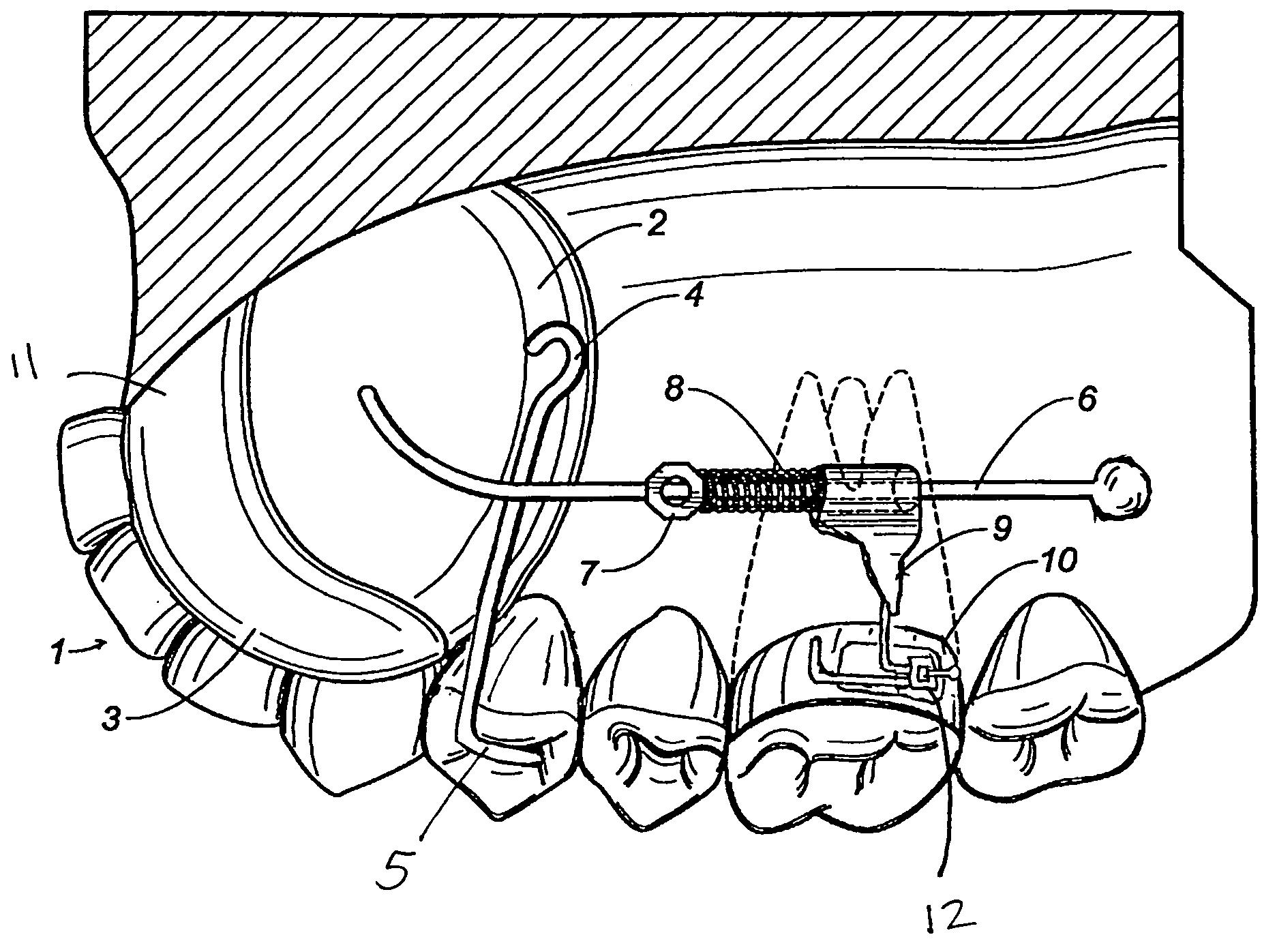 Maxillary molar distalization jig