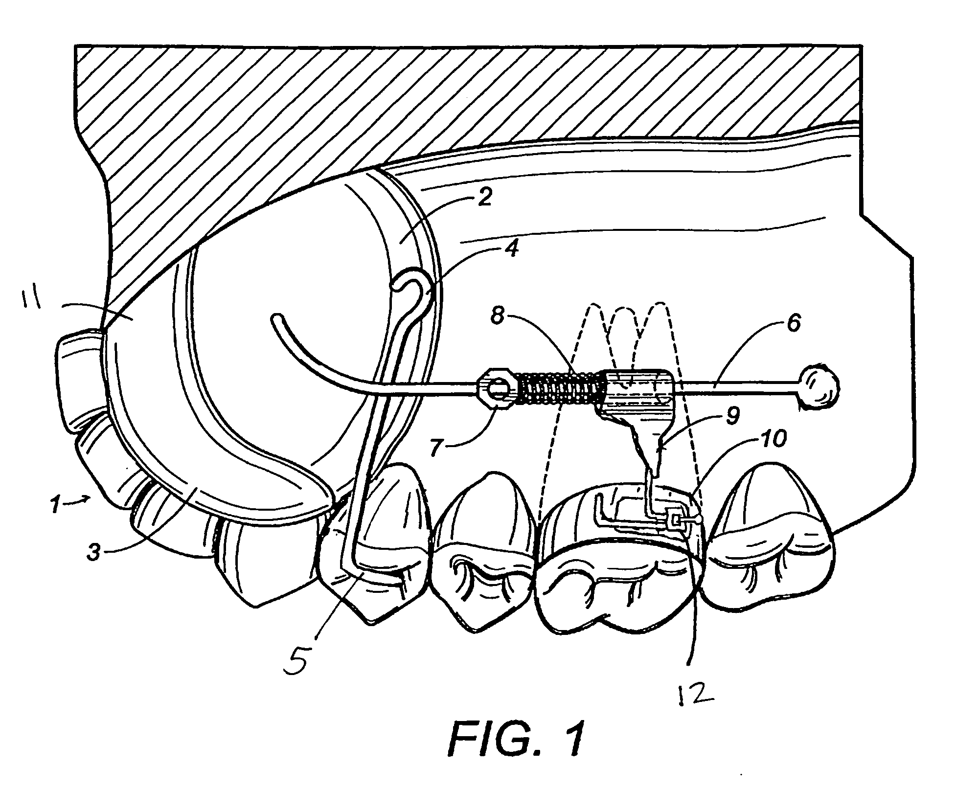 Maxillary molar distalization jig