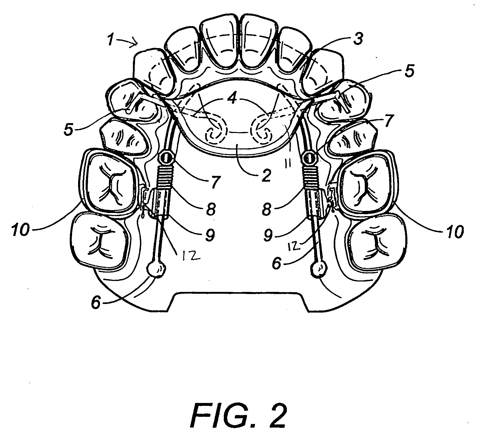 Maxillary molar distalization jig