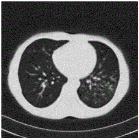 Low-dose CT image statistical reconstruction method based on discrete shear wave regularization