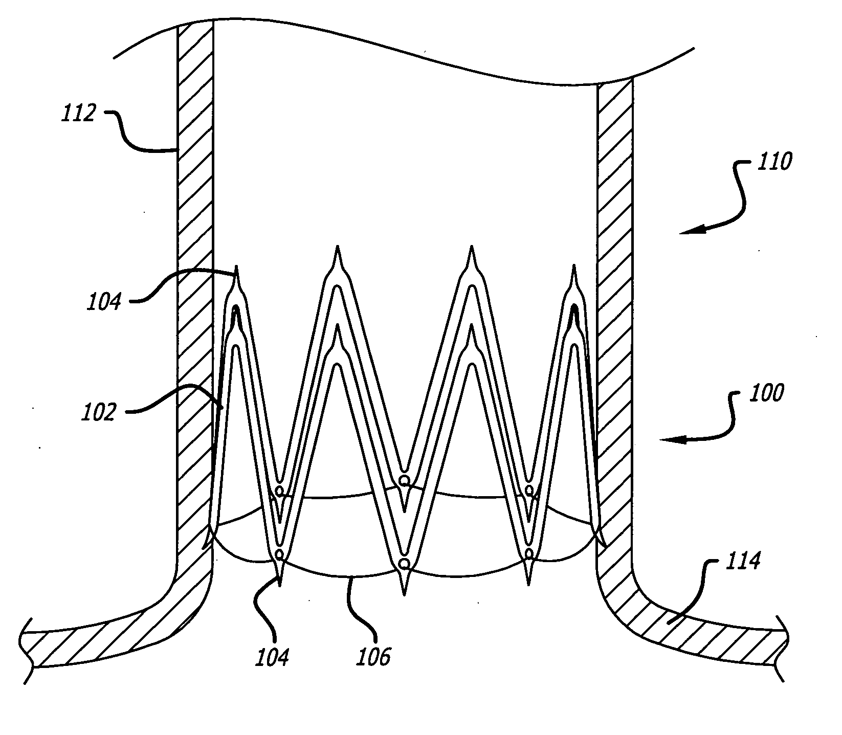 Two-stage scar generation for treating atrial fibrillation