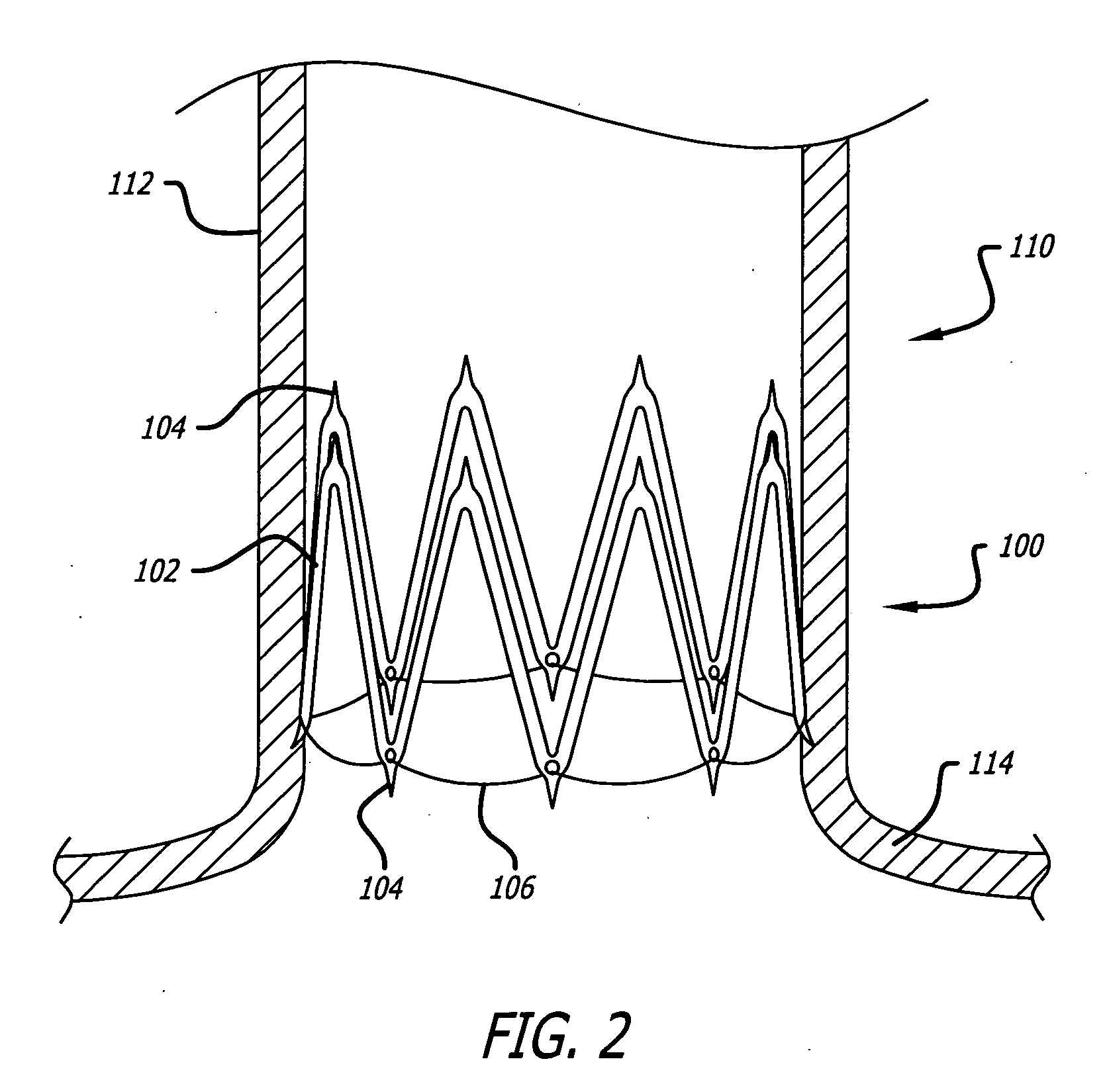 Two-stage scar generation for treating atrial fibrillation