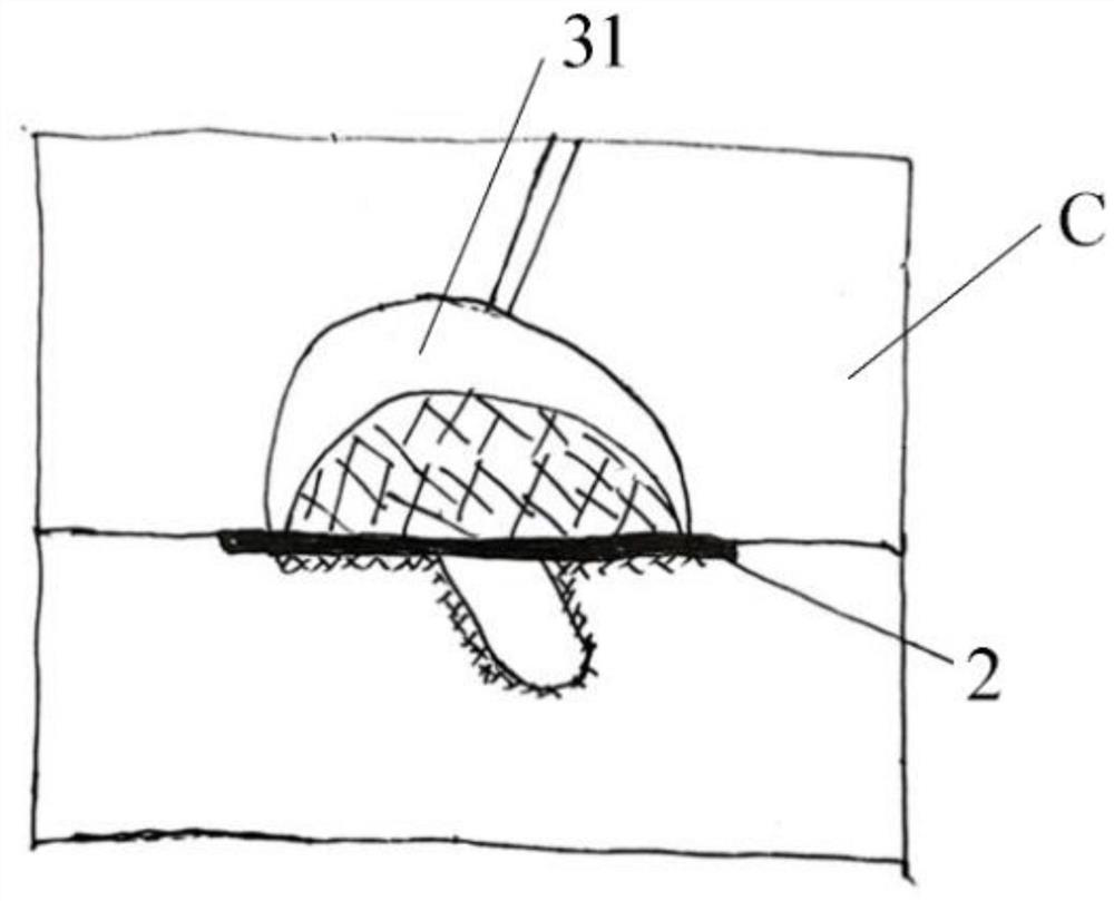 Porous metal and PEEK composite implanted joint prosthesis and preparation method