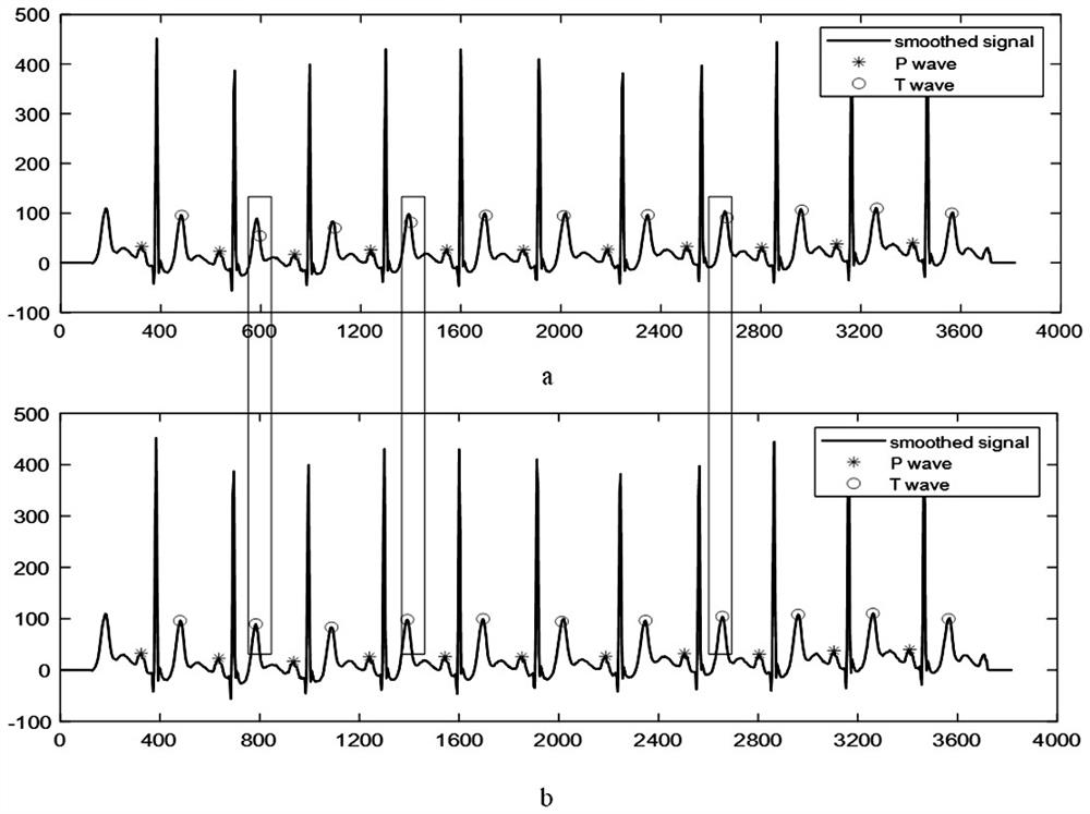 Method for detecting P and T characteristic waves of electrocardiosignal