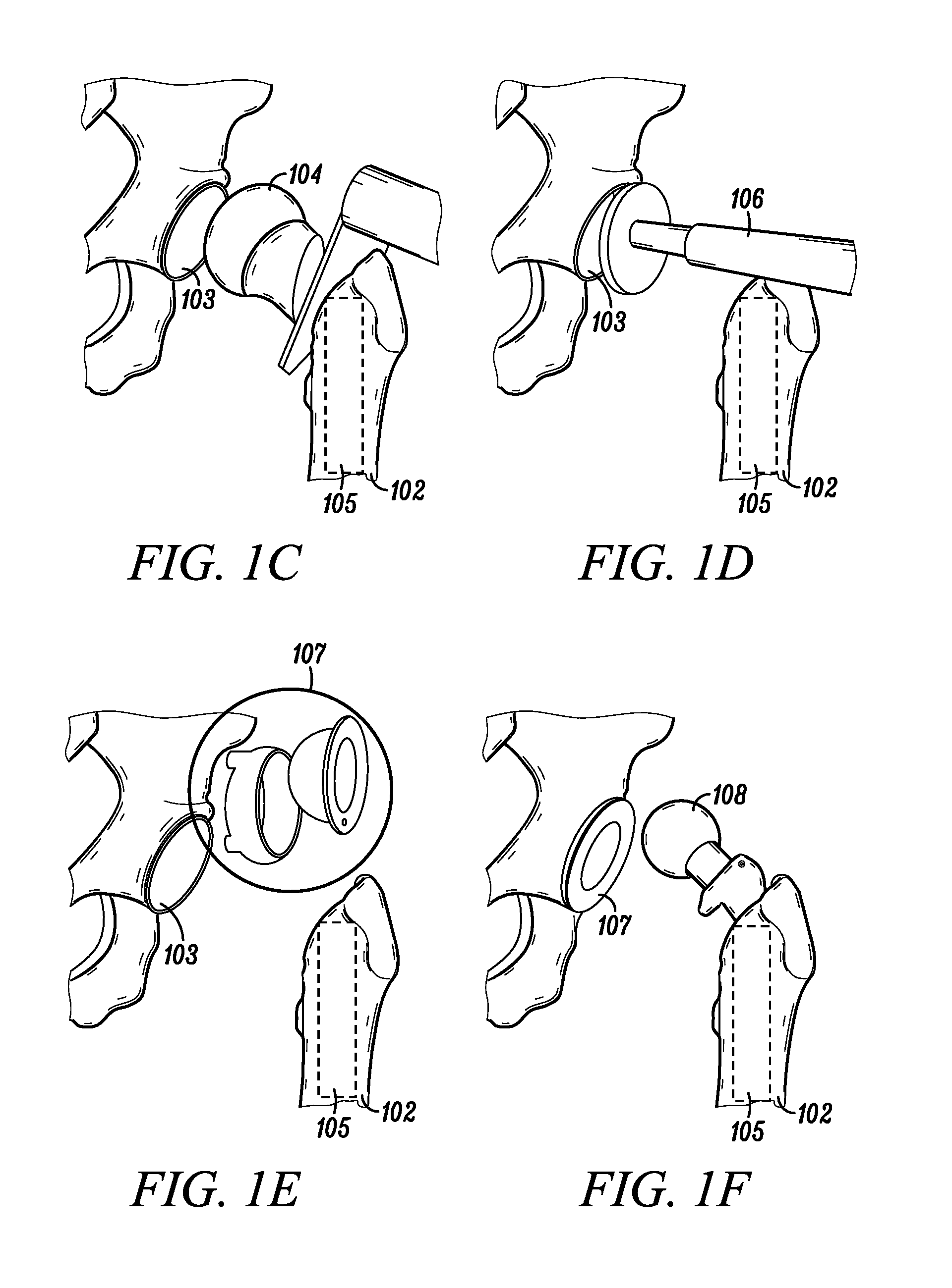 Posterior tissue retractor for use in hip replacement surgery