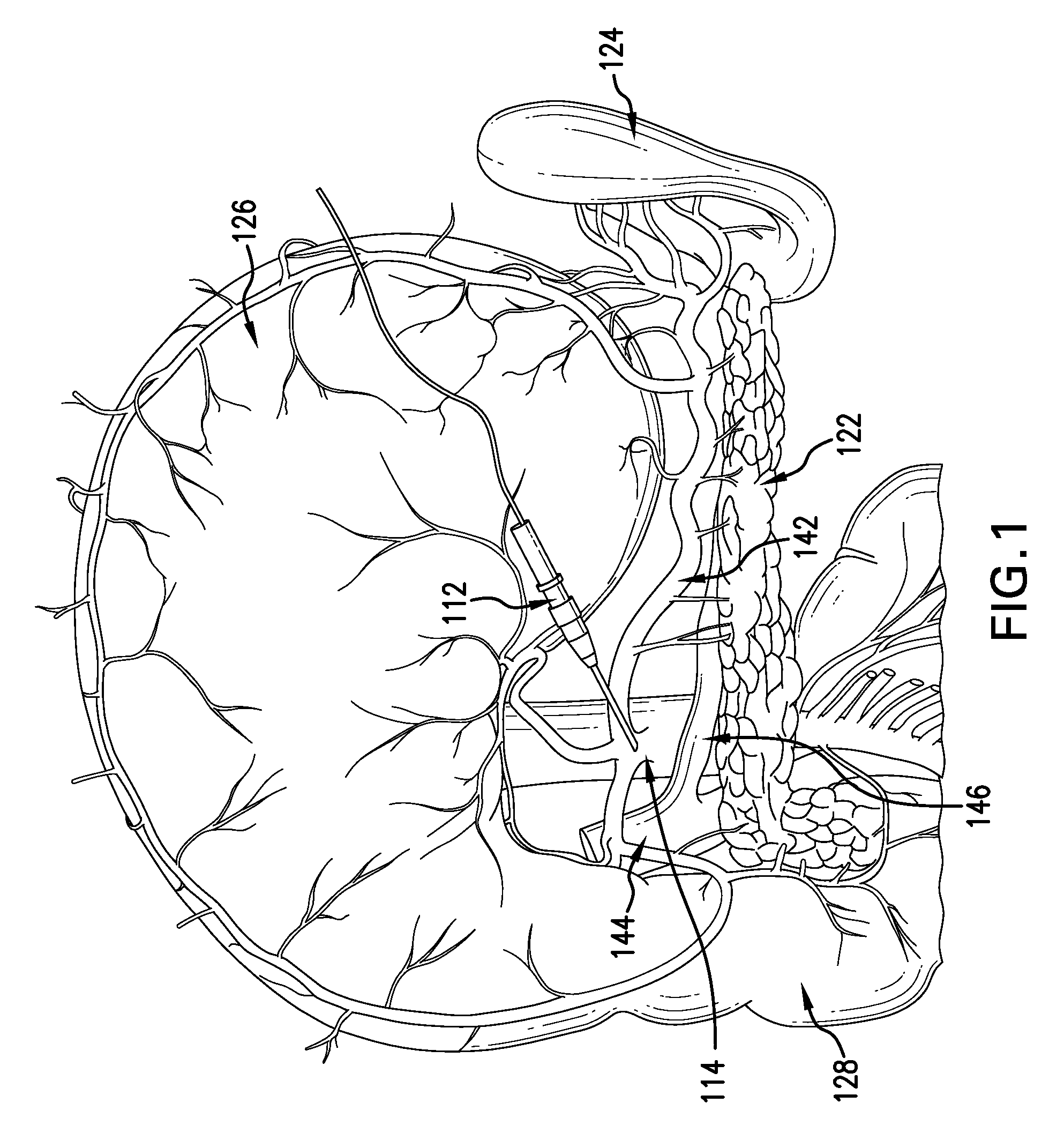 Method for reversing recent-onset type 1 diabetes (T1D) by administering substance P (sP)