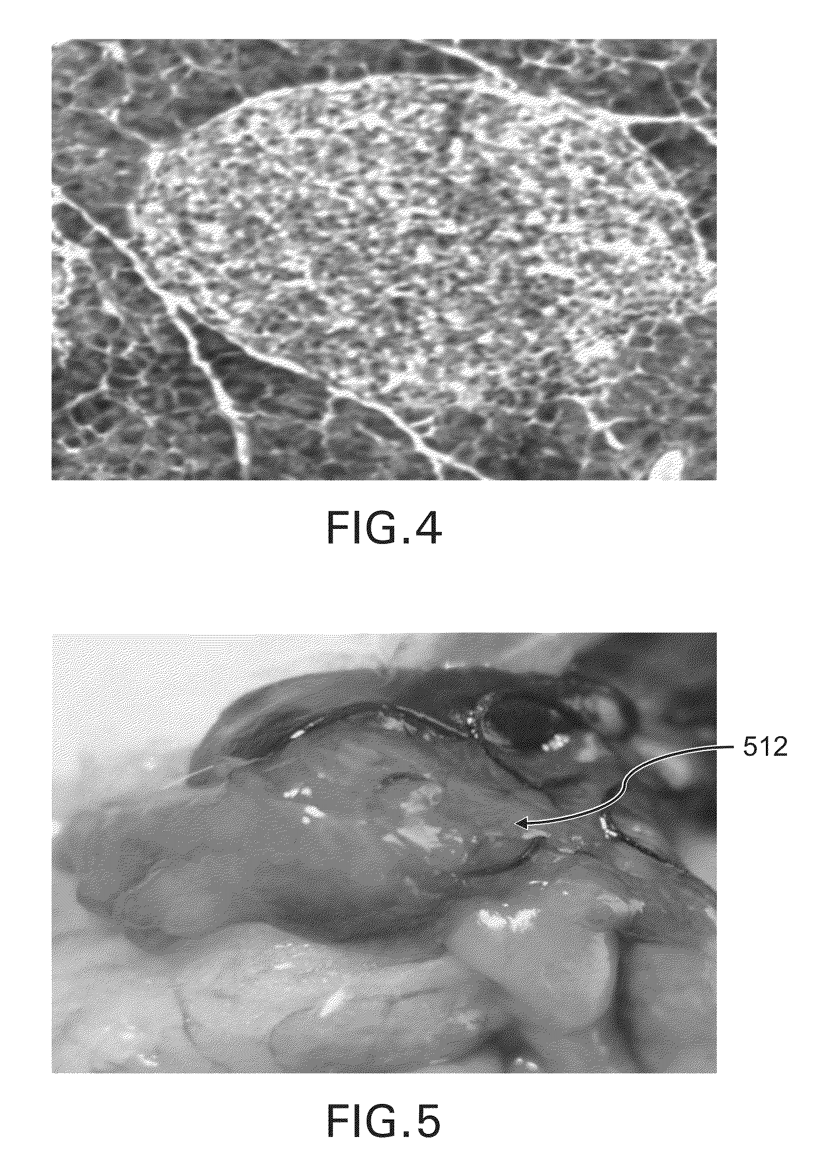 Method for reversing recent-onset type 1 diabetes (T1D) by administering substance P (sP)