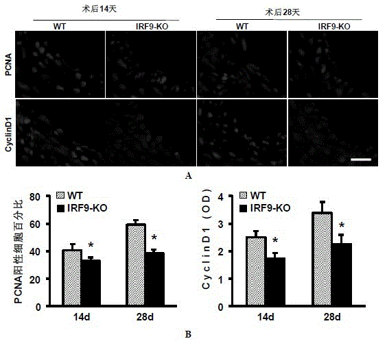 The function of irf9 in restenosis after stent and endarterectomy and the application of its inhibitor