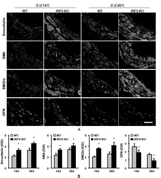 The function of irf9 in restenosis after stent and endarterectomy and the application of its inhibitor