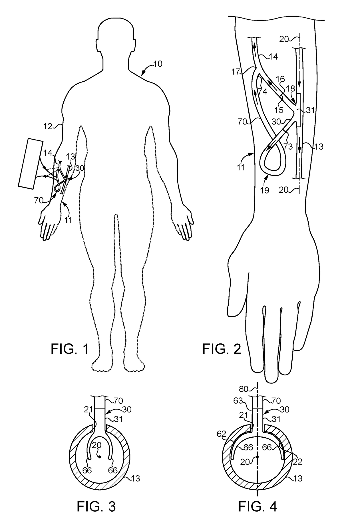 Combined arterial venous fistula graft implant and method of using same