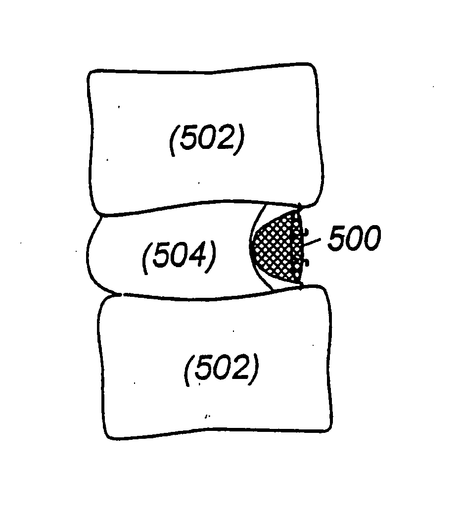 Methods for treating a defect in the annulus fibrosis