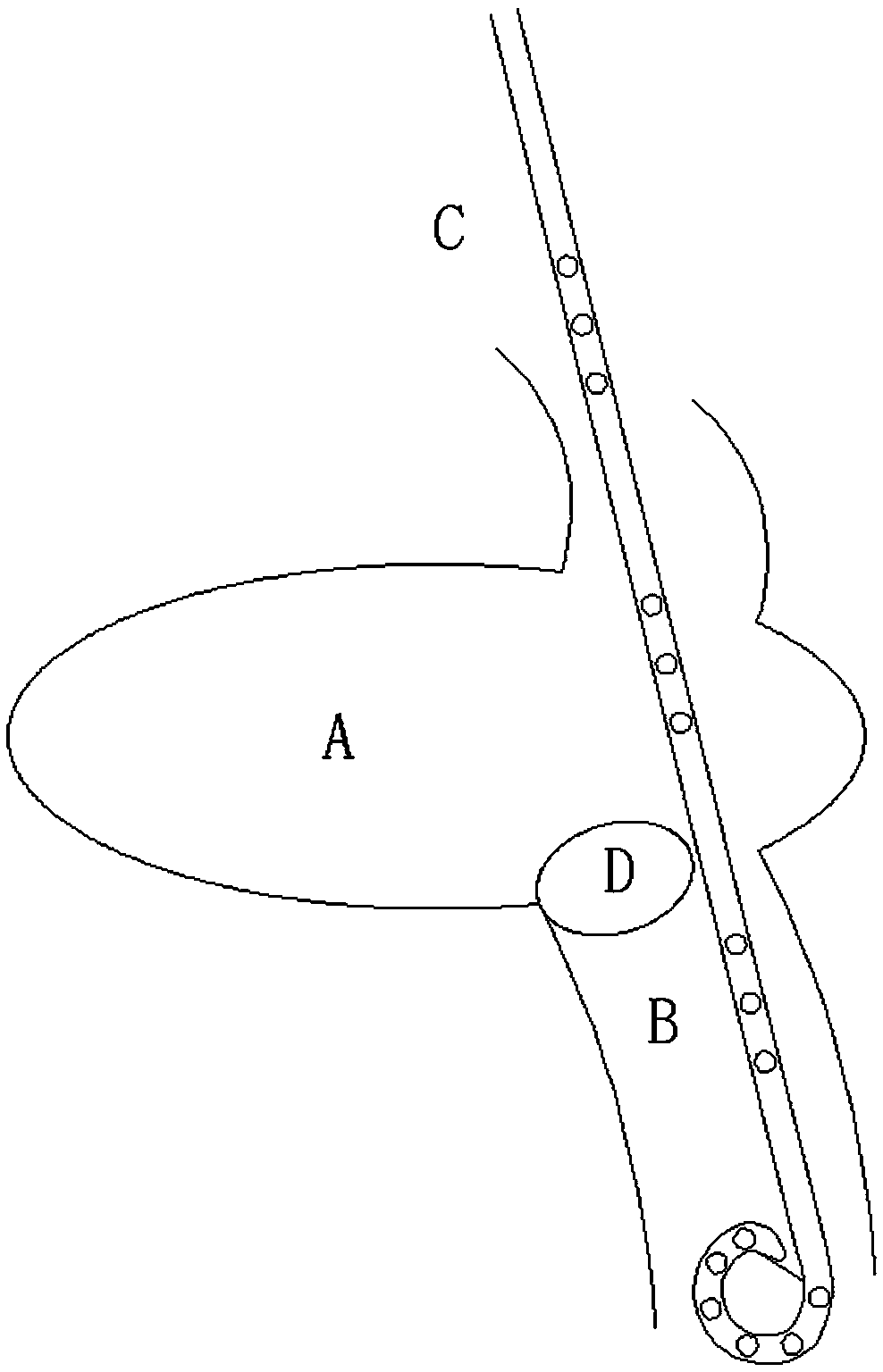 Internal and external drainage tube for advanced liver cancer