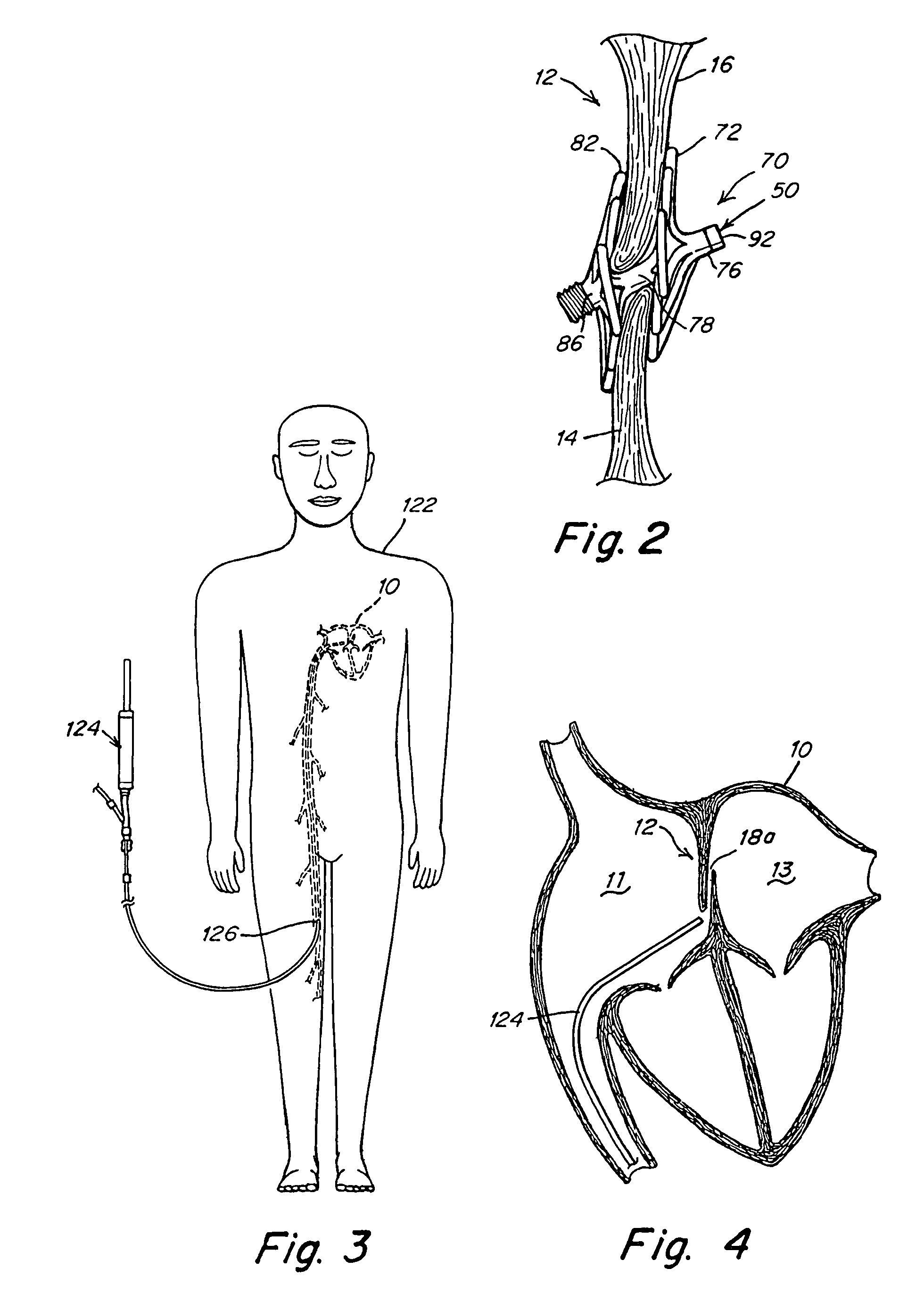 Screw catch mechanism for PFO occluder and method of use